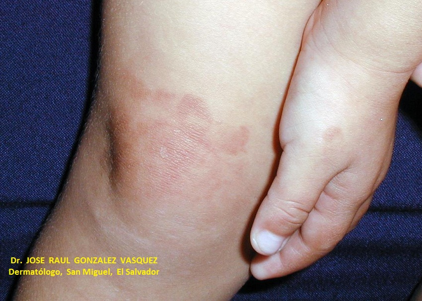 FITOFOTODERMATITIS -  por furocumarinas (zumo de limón)