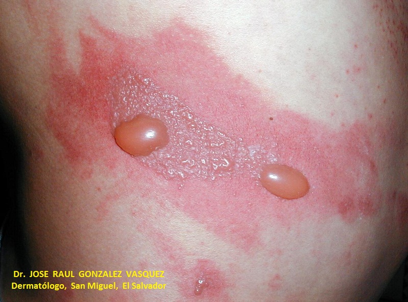 FITOFOTODERMATITIS -  por psoralenos