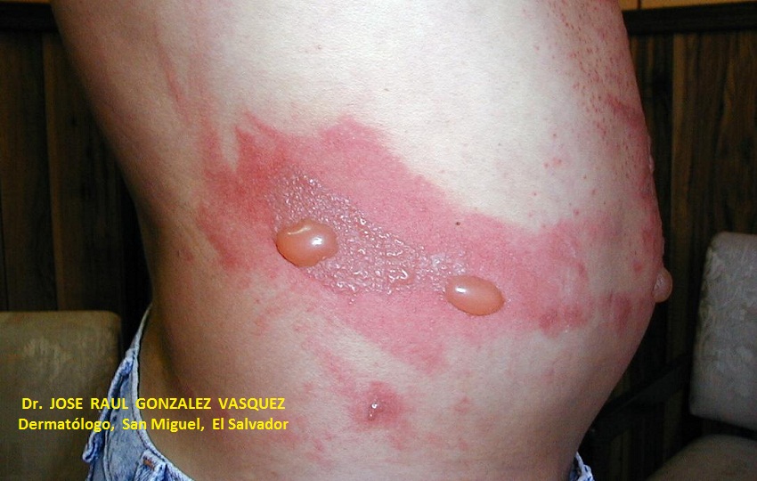 FITOFOTODERMATITIS -  por psoralenos