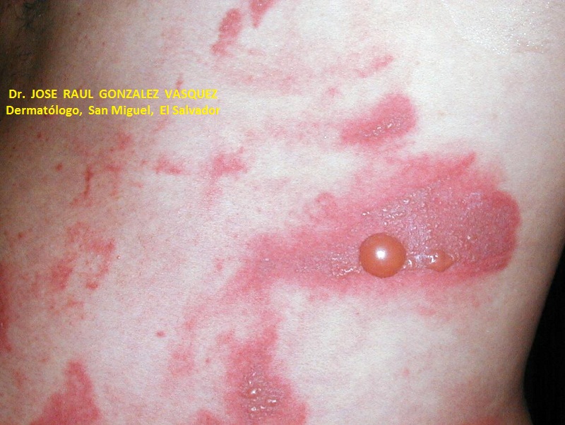 FITOFOTODERMATITIS -  por psoralenos