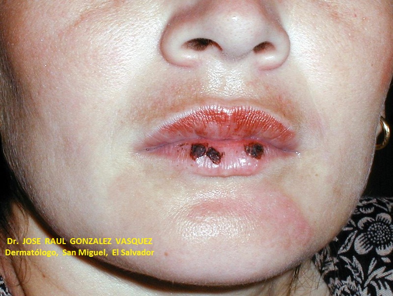 FITOFOTODERMATITIS por furocumarinas