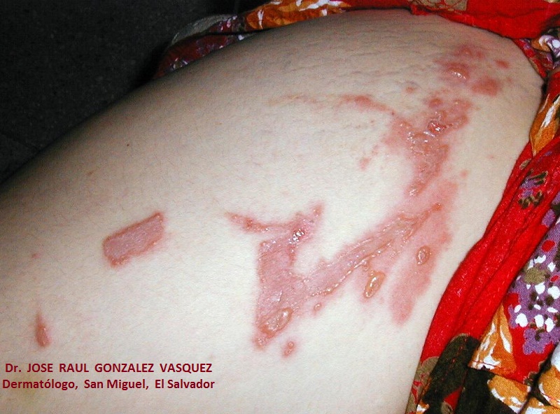 FITOFOTODERMATITIS por furocumarinas