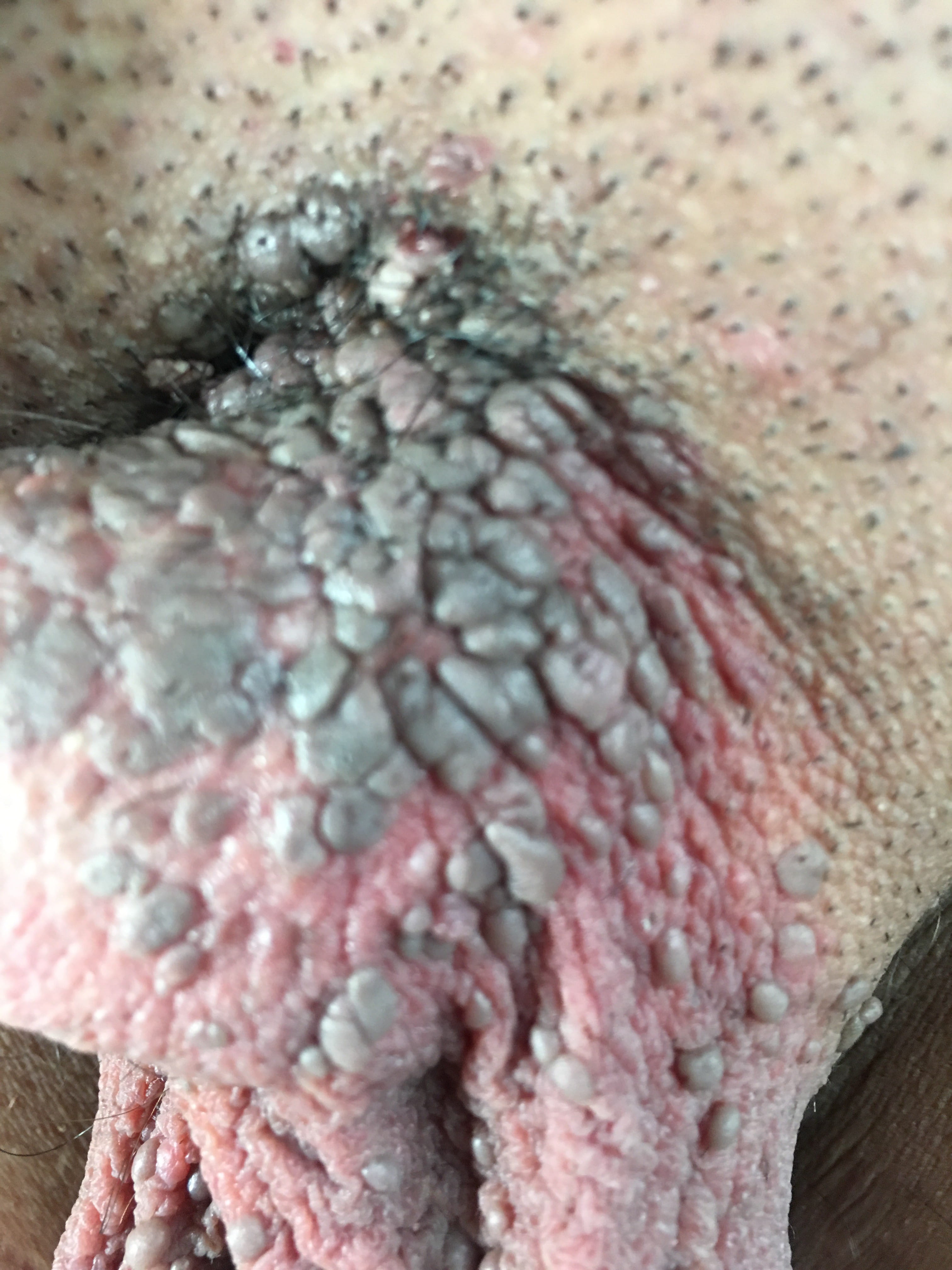 PAPULOSIS BOWENOIDE en area genital