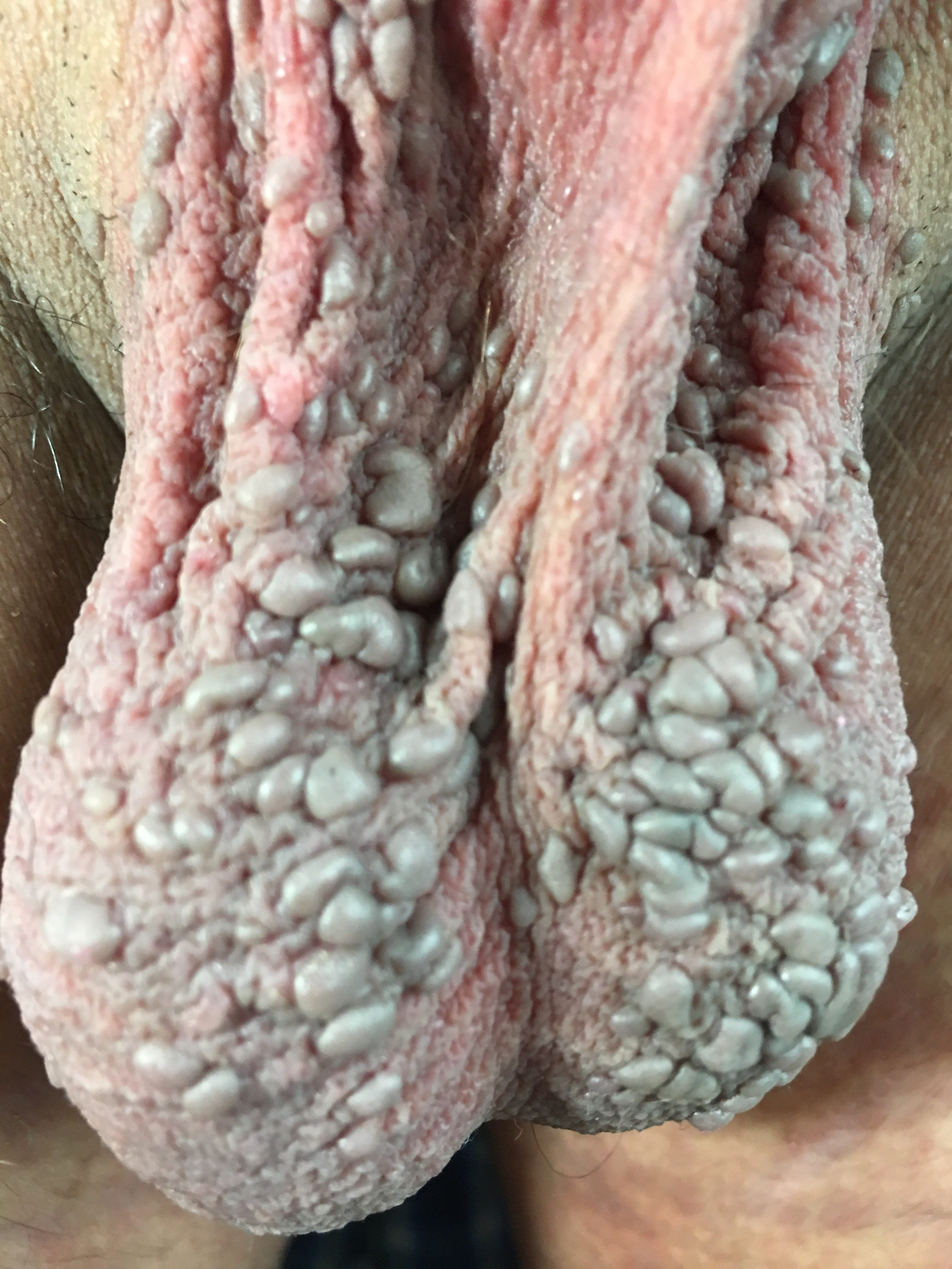 PAPULOSIS BOWENOIDE en area genital