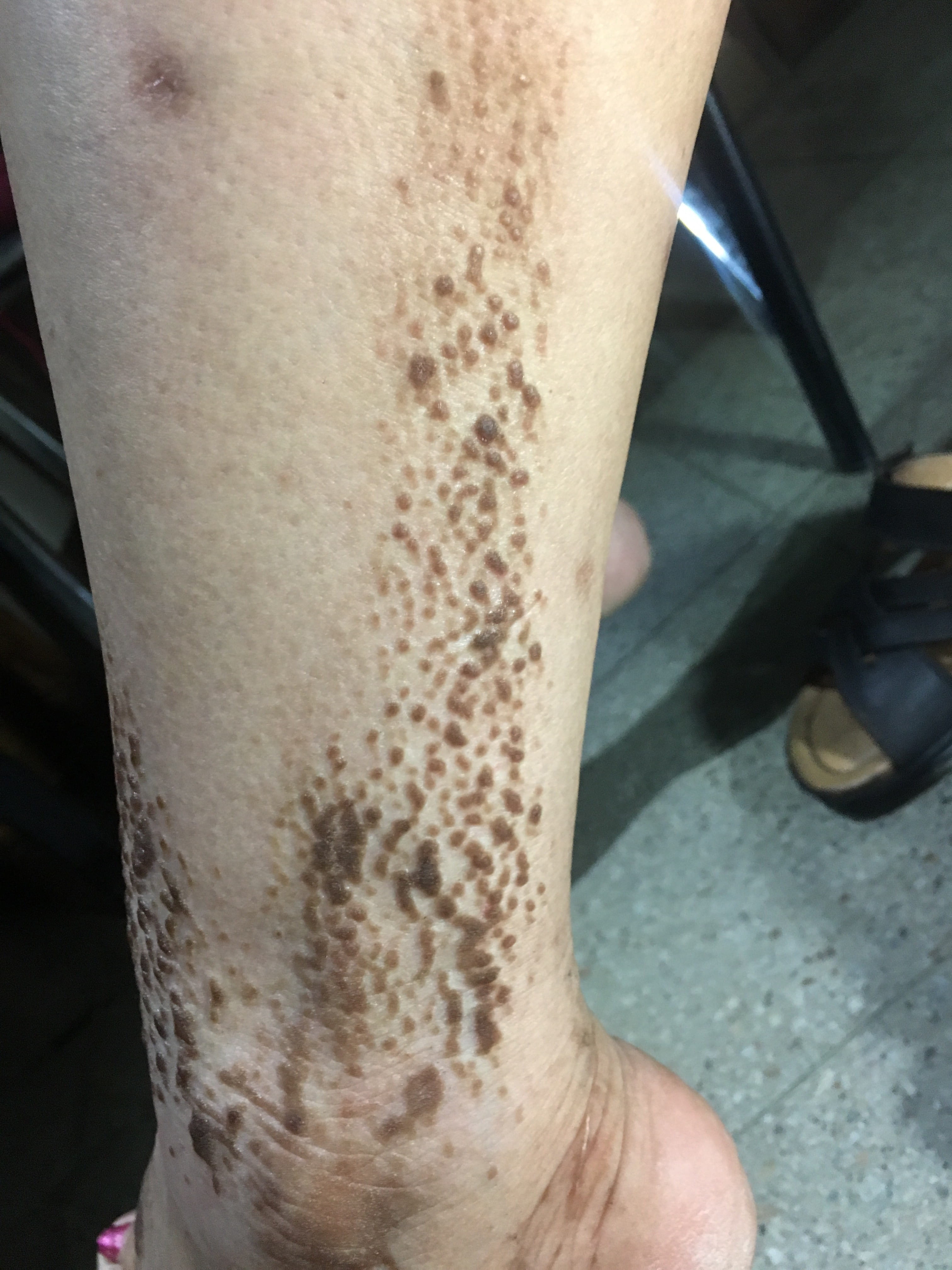LIQUEN AMILOIDE