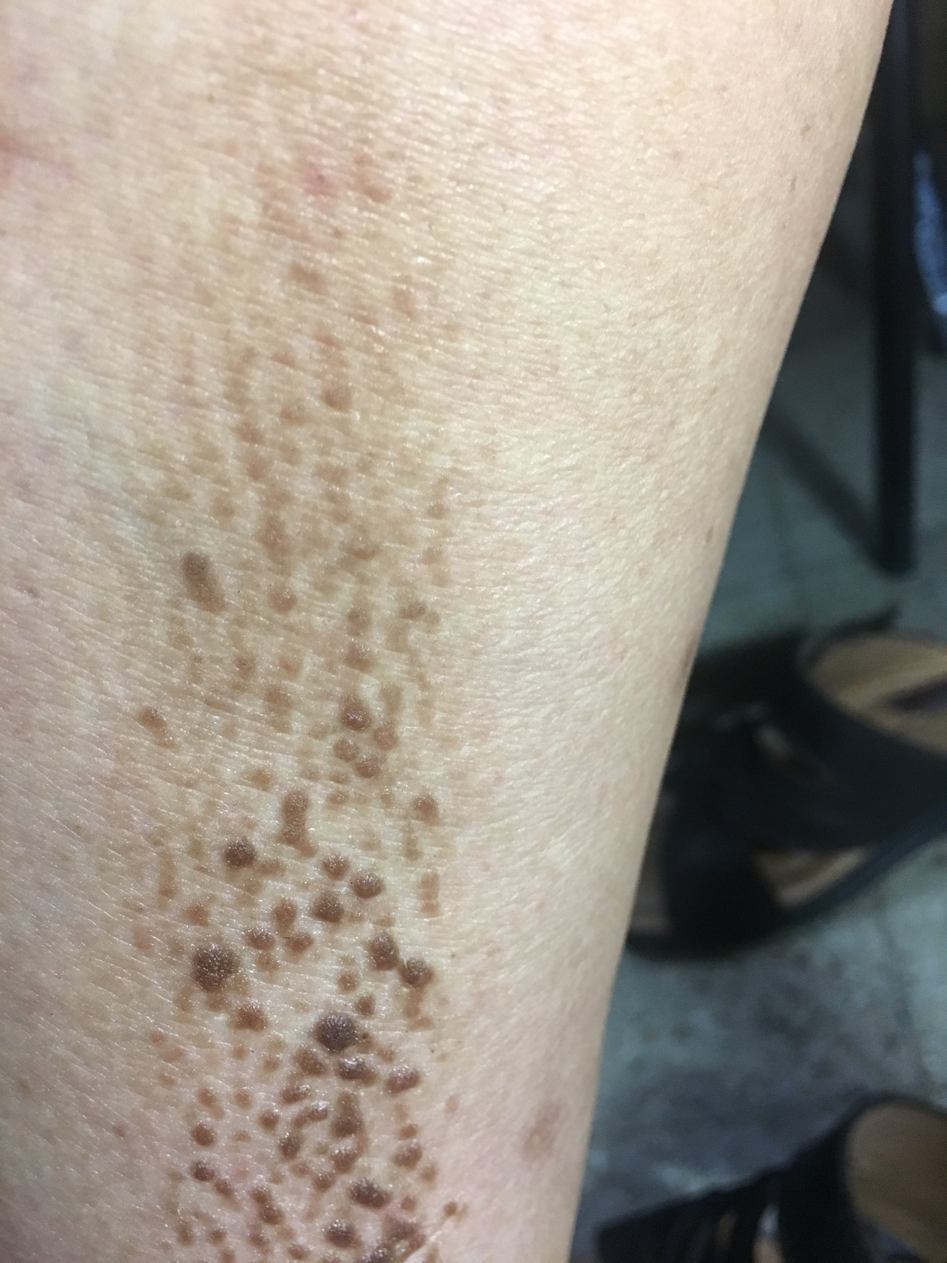 LIQUEN AMILOIDE