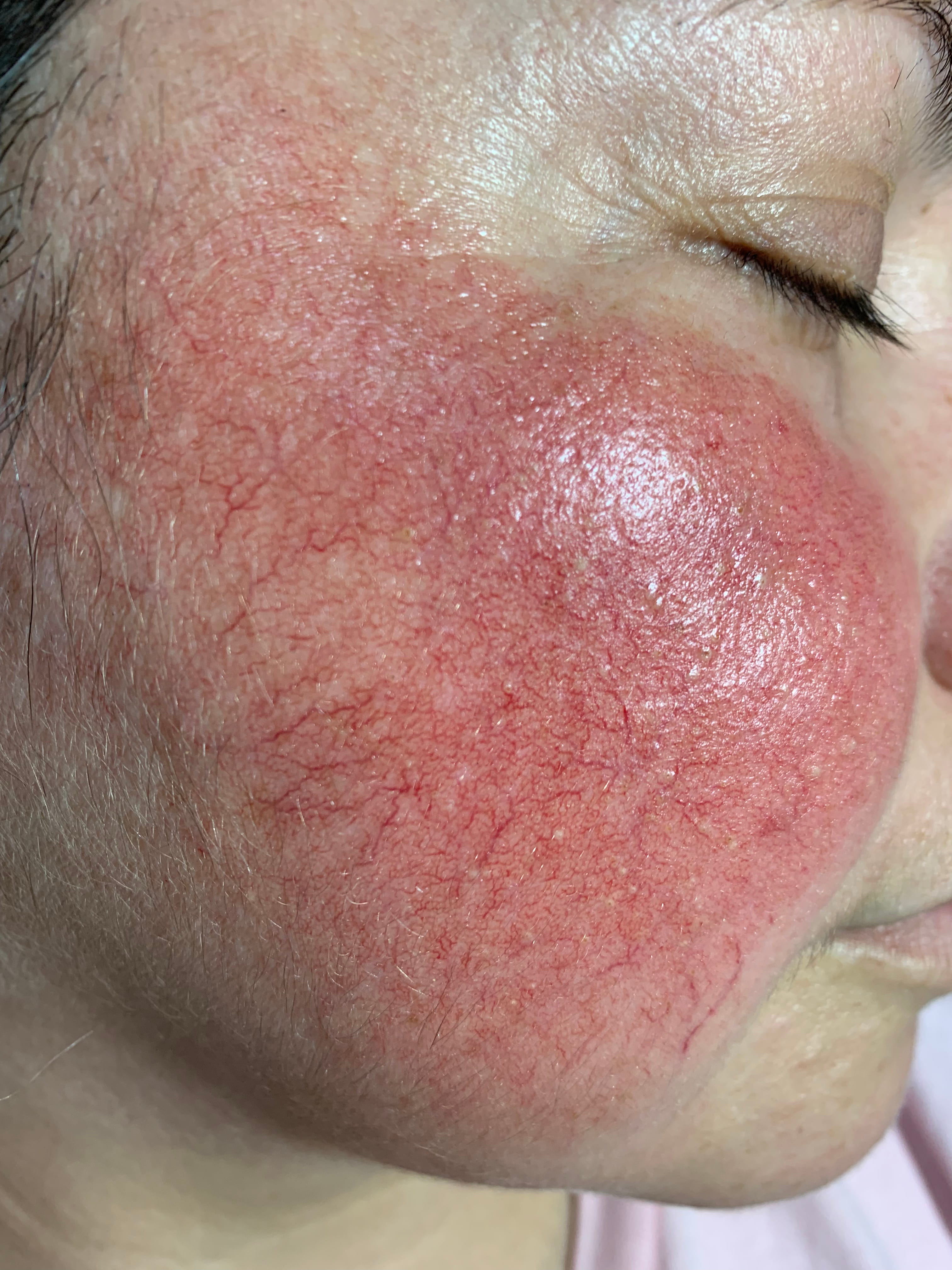 CORTICODAÑO Atrofia -eritema - telangiectasias