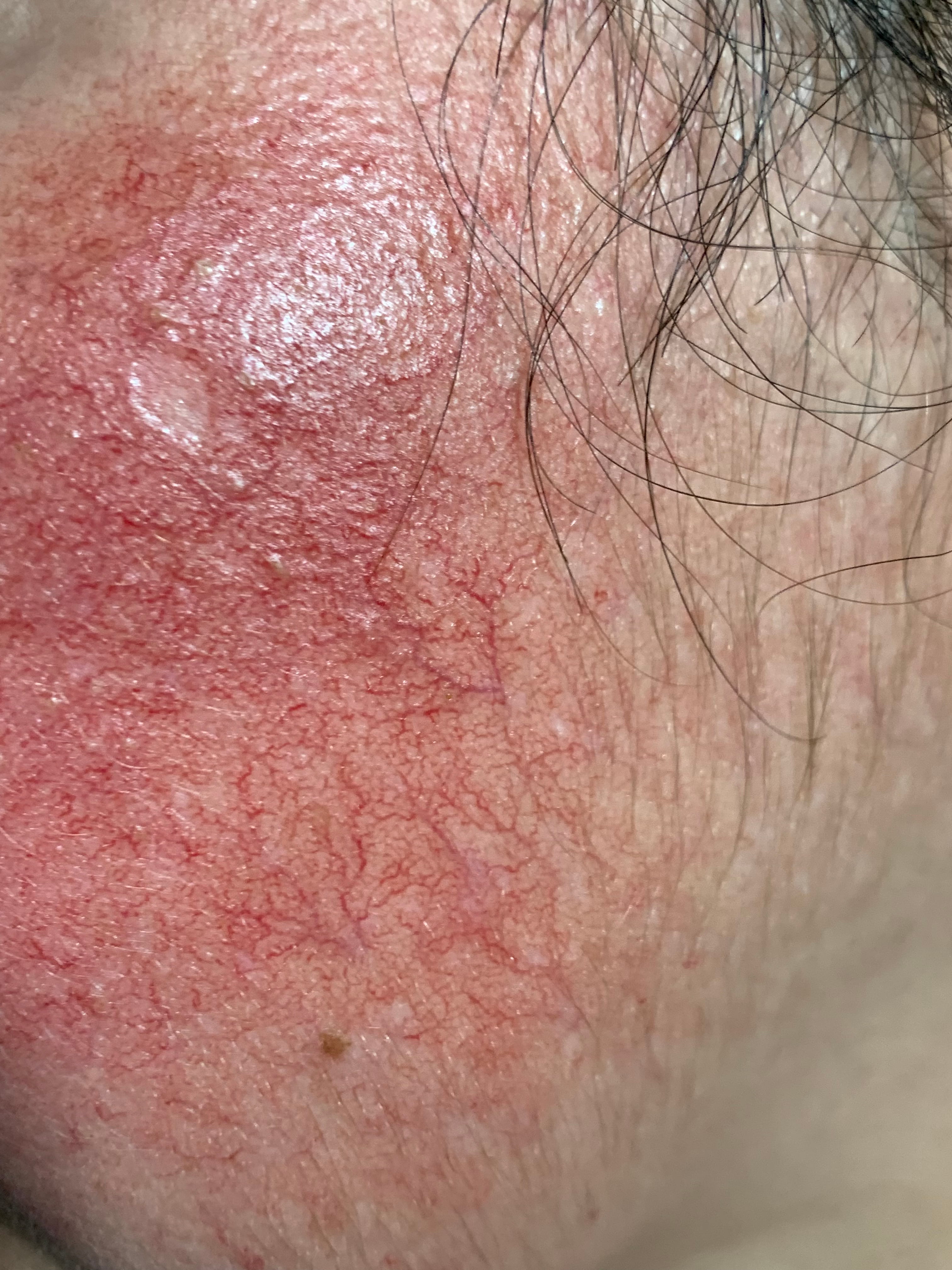 CORTICODAÑO Atrofia -eritema - telangiectasias