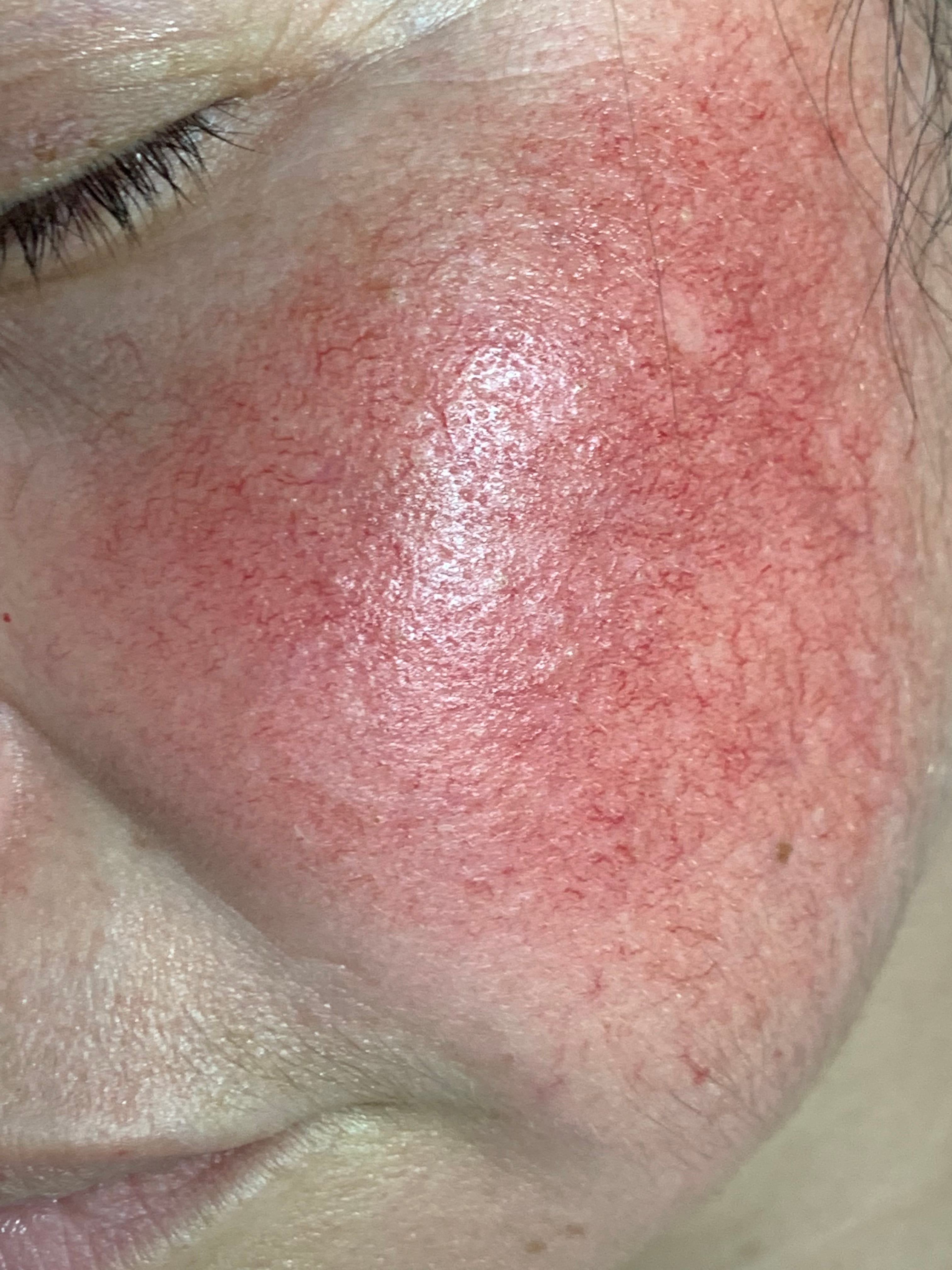 CORTICODAÑO Atrofia -eritema - telangiectasias