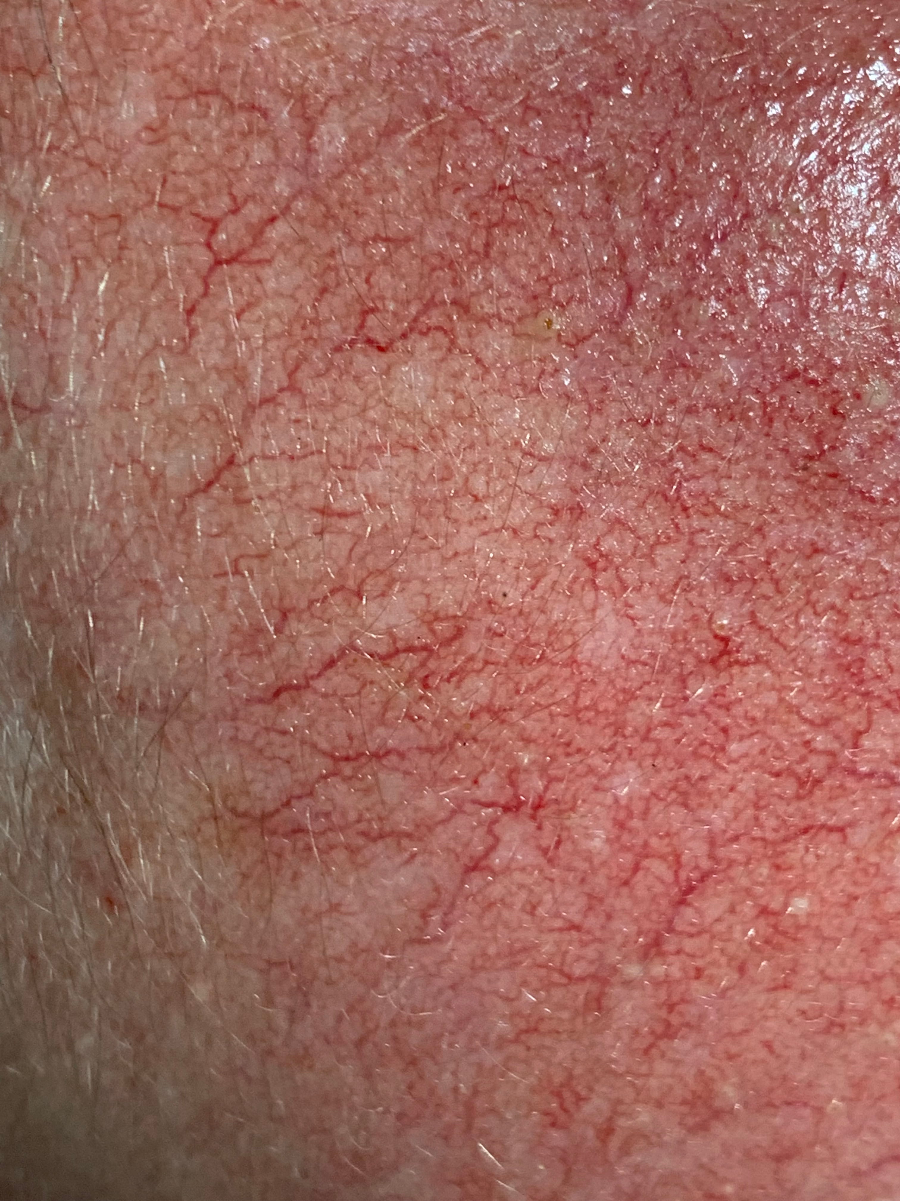 CORTICODAÑO Atrofia -eritema - telangiectasias