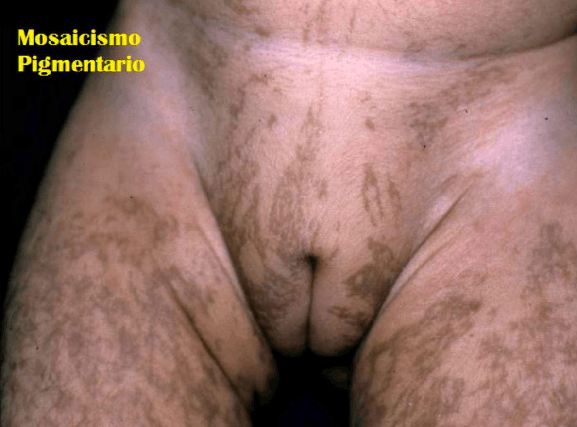 MOSAICISMO PIGMENTARIO