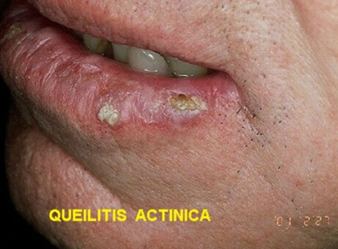 QUEILITIS ACTINICA
