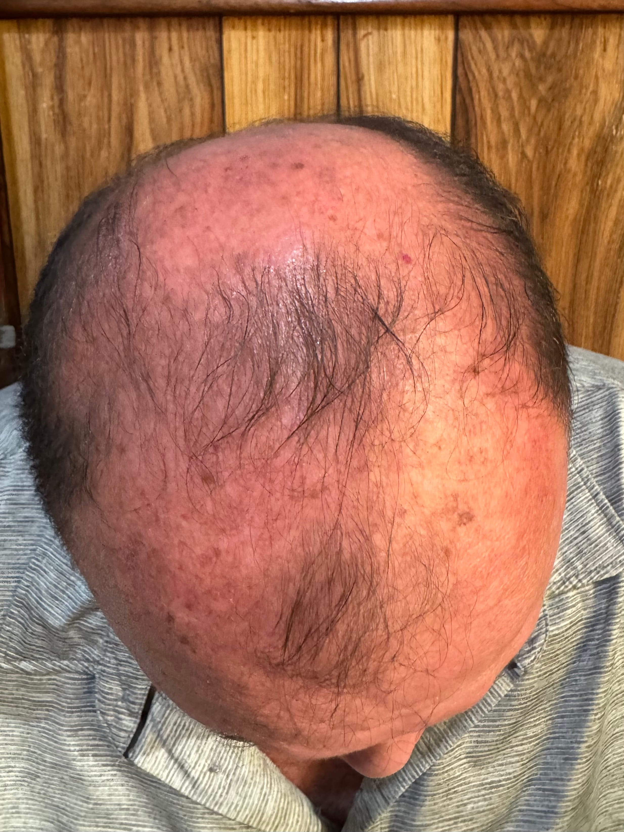ALOPECIA ANDROGENETICA masculina