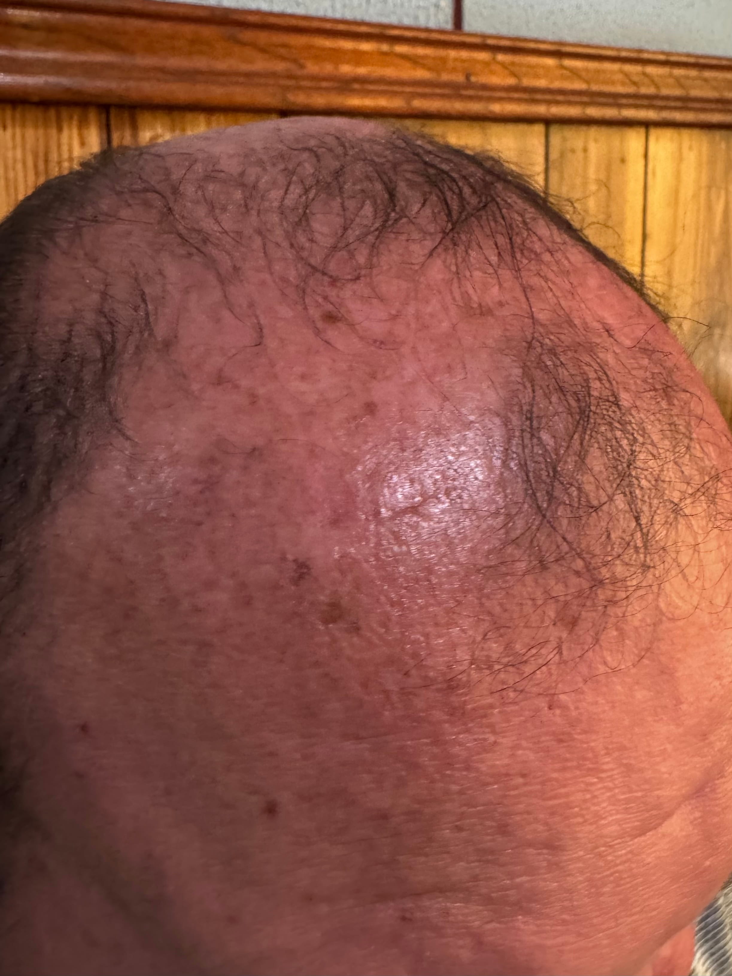 ALOPECIA ANDROGENETICA masculina