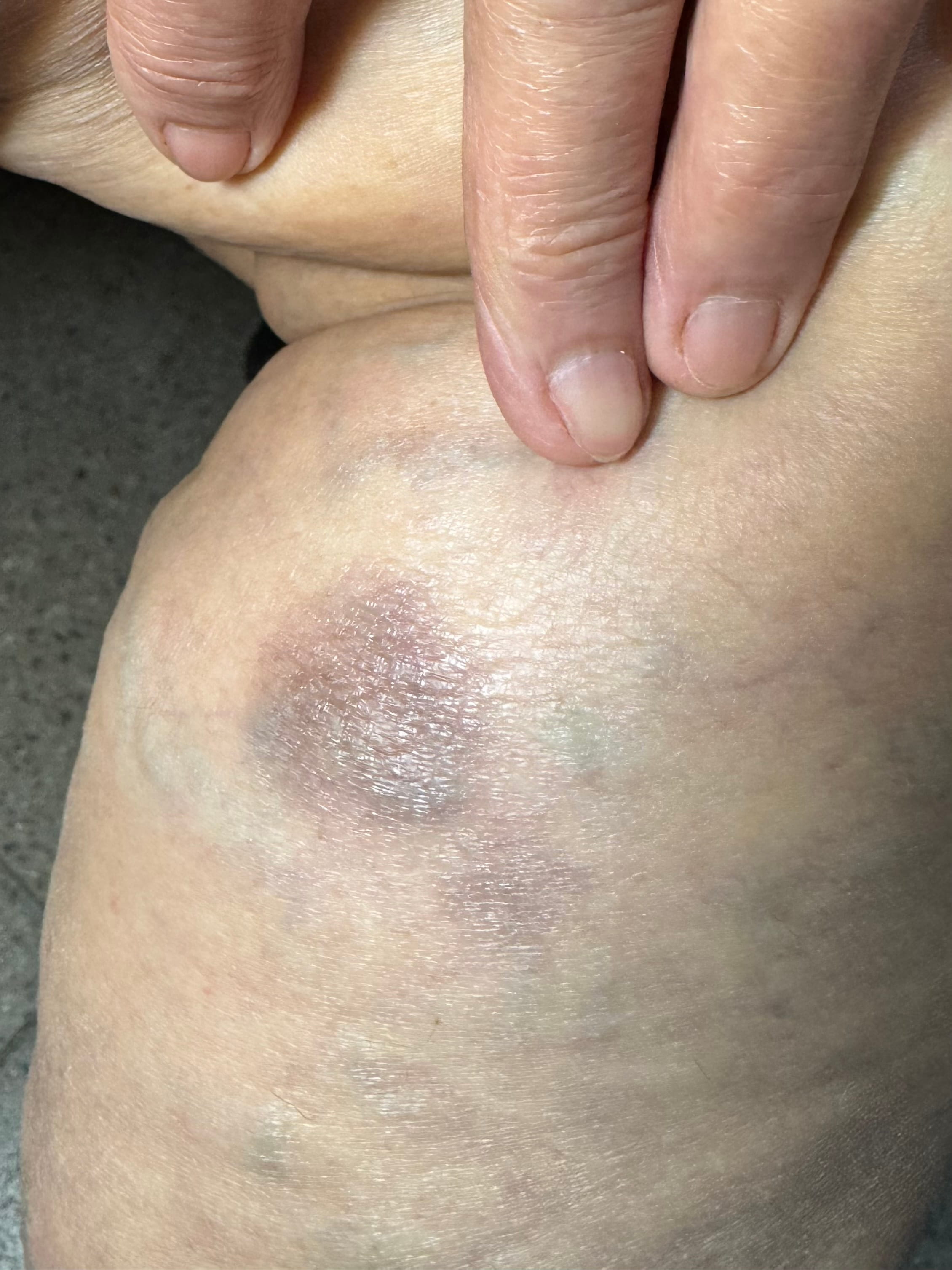 ERITEMA PIGMETADO FIJO - por dipirona