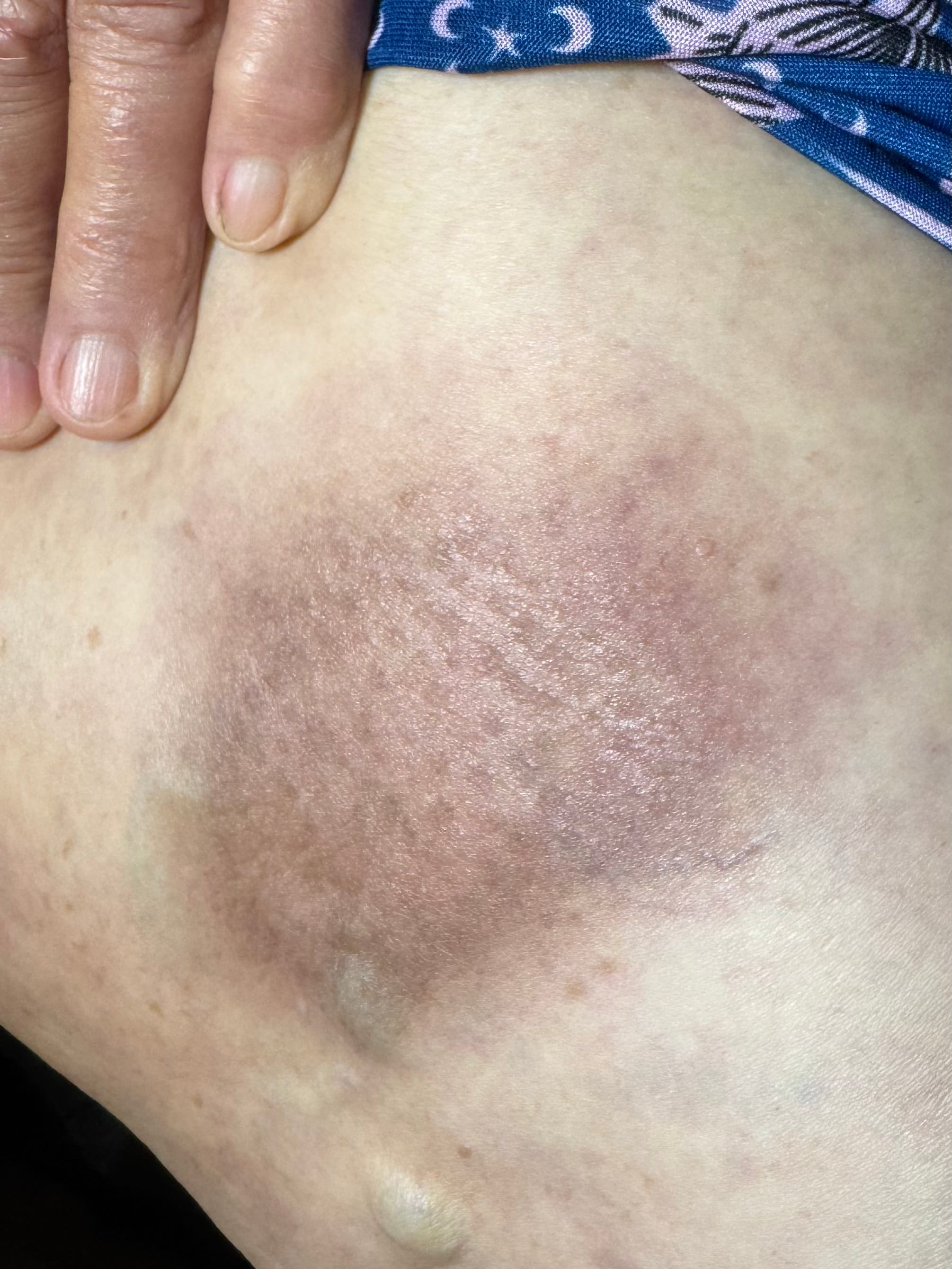 ERITEMA PIGMETADO FIJO - por dipirona