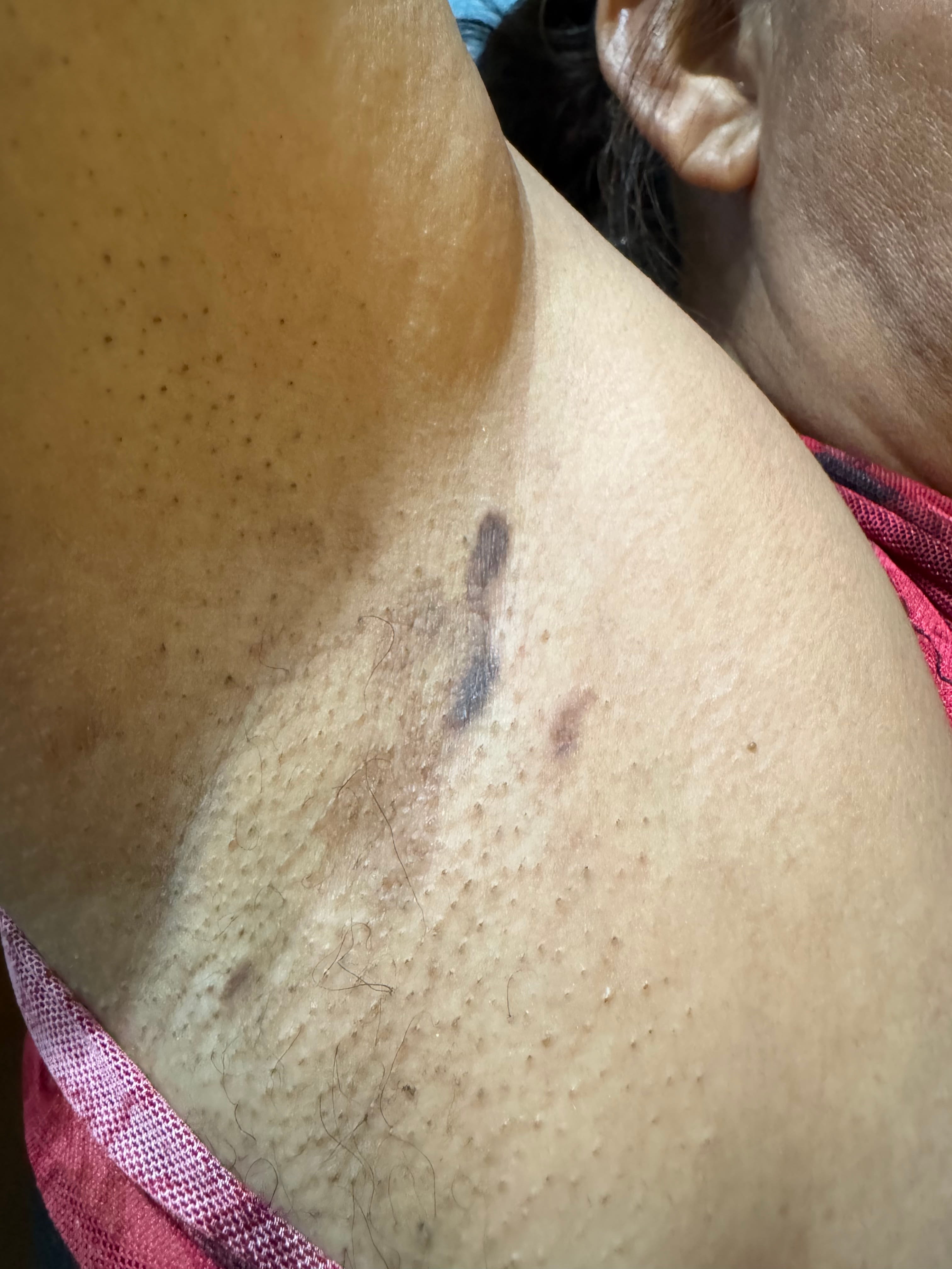 HIPERCROMIA POST Liquen plano