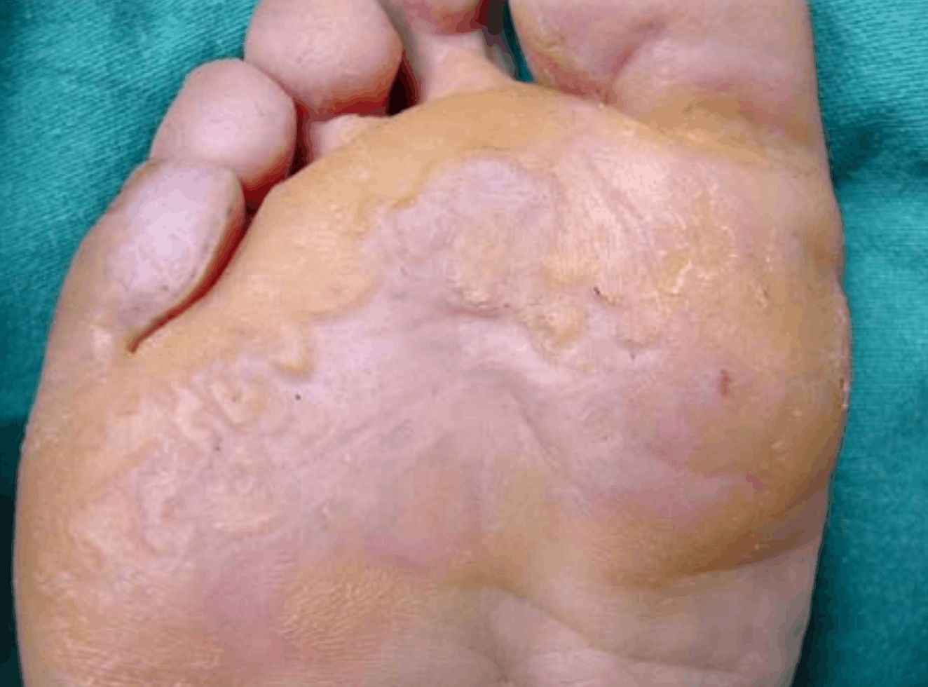 QUERATODERMIA PLANTAR