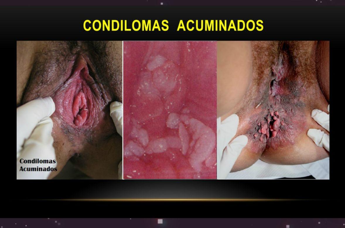 CONDILOMAS ACUMINADOS