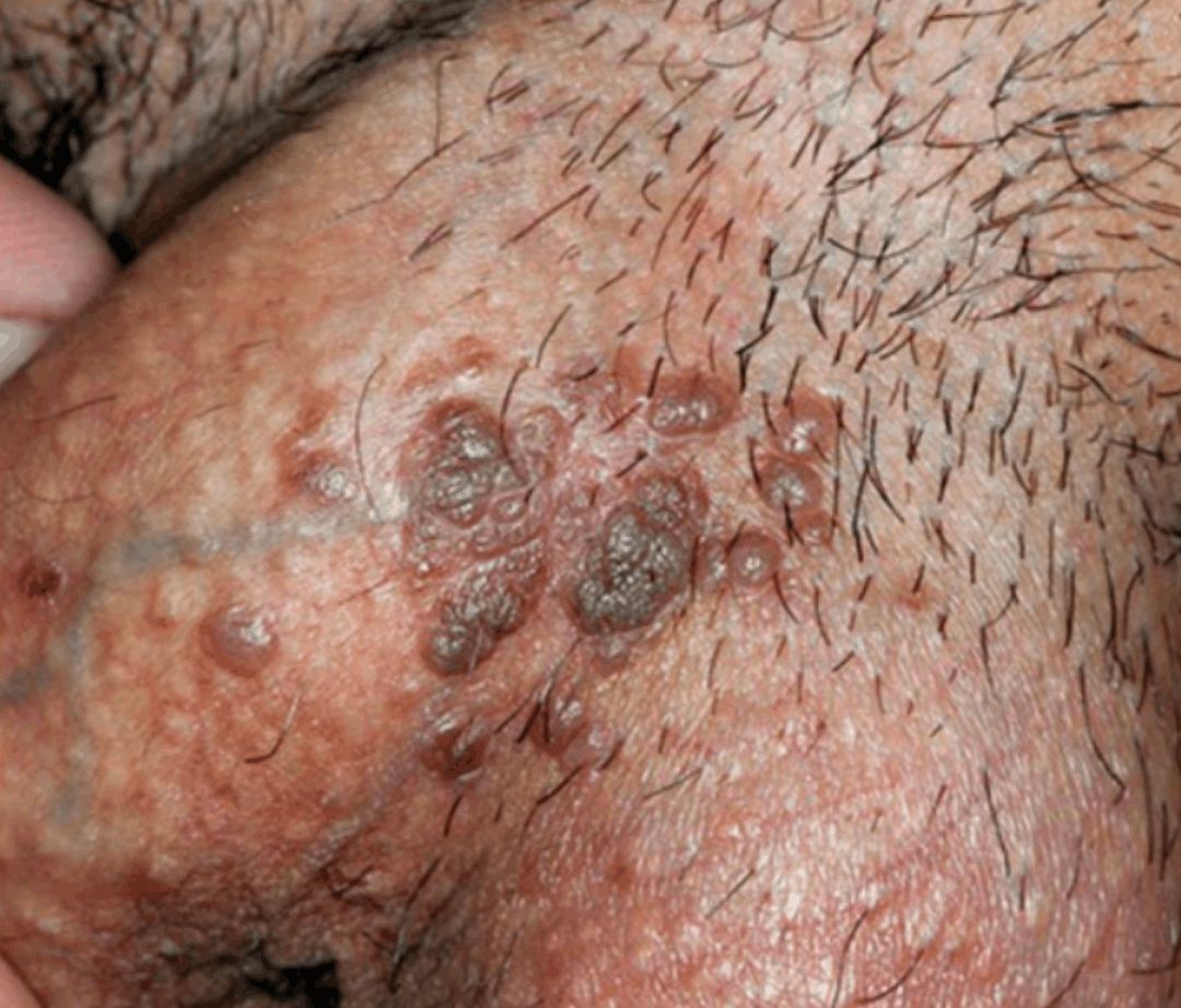 PAPULOSIS BOWENOIDE en area genital