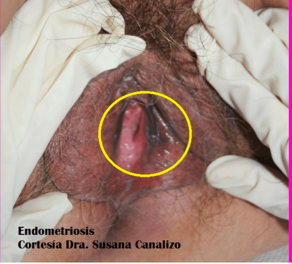 ENDOMETRIOSIS VULVAR