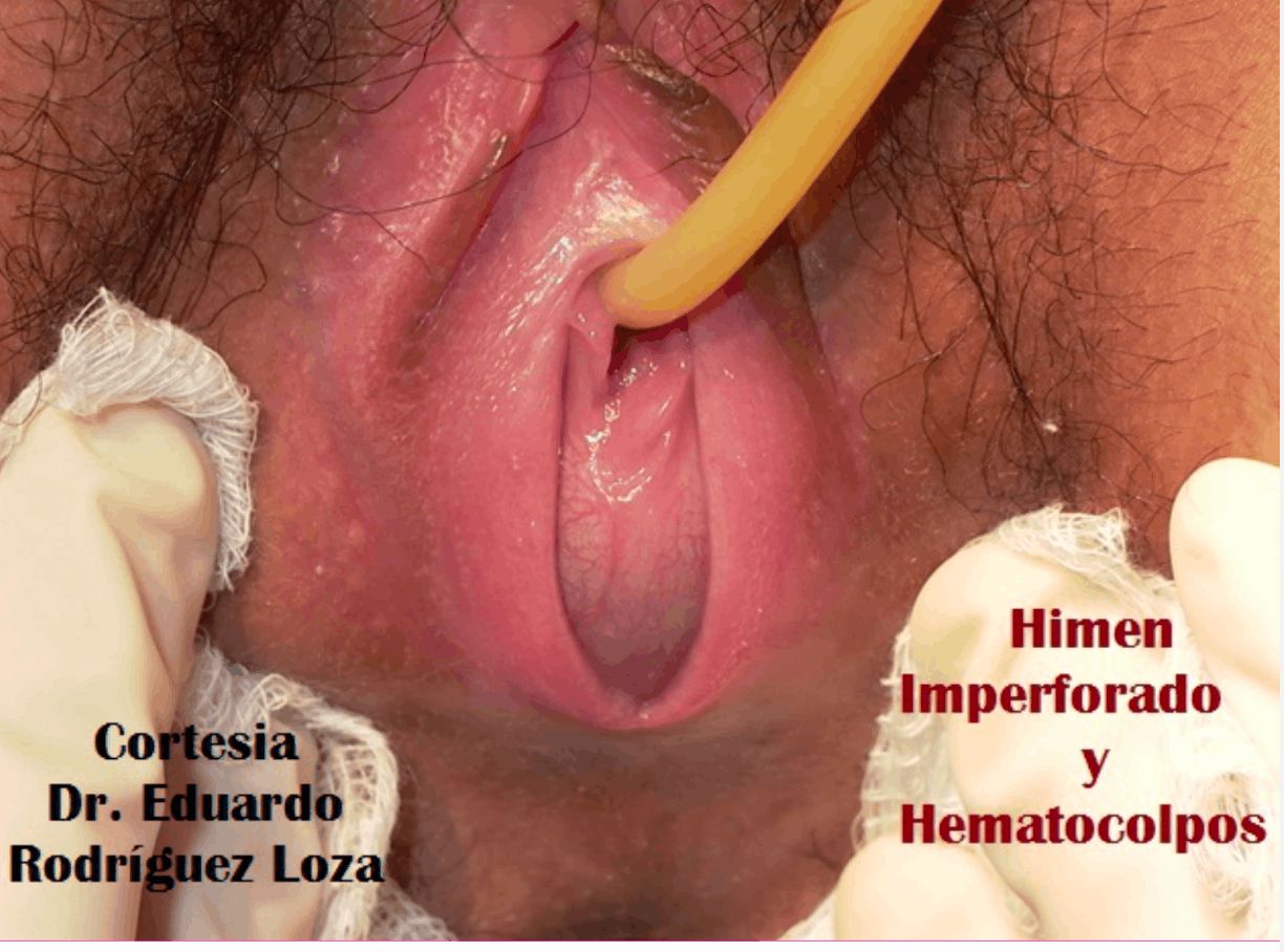 HIMEN IMPERFORADO Y HEMATOCOLPOS