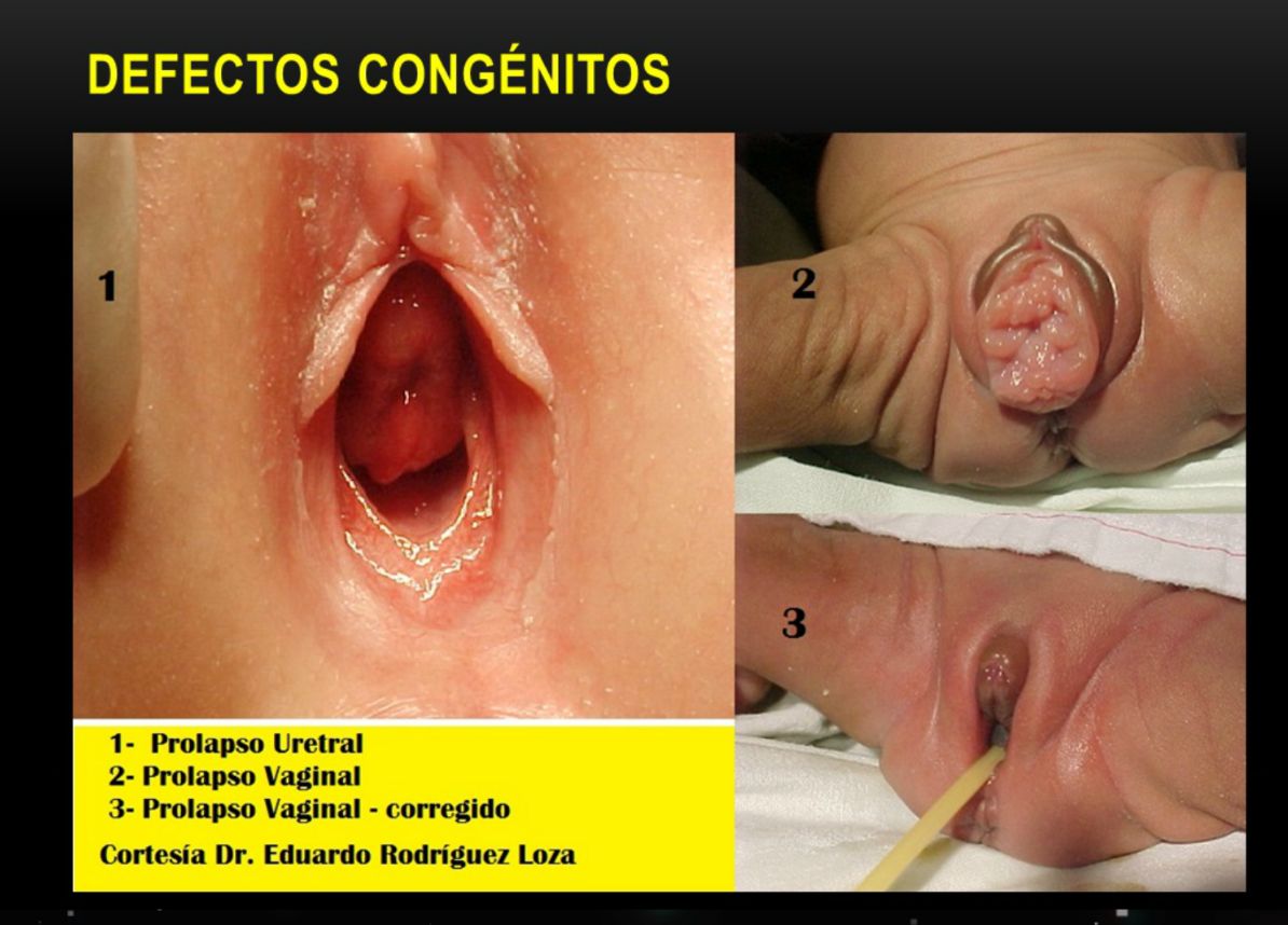 DEFECTOS CONGENITOS