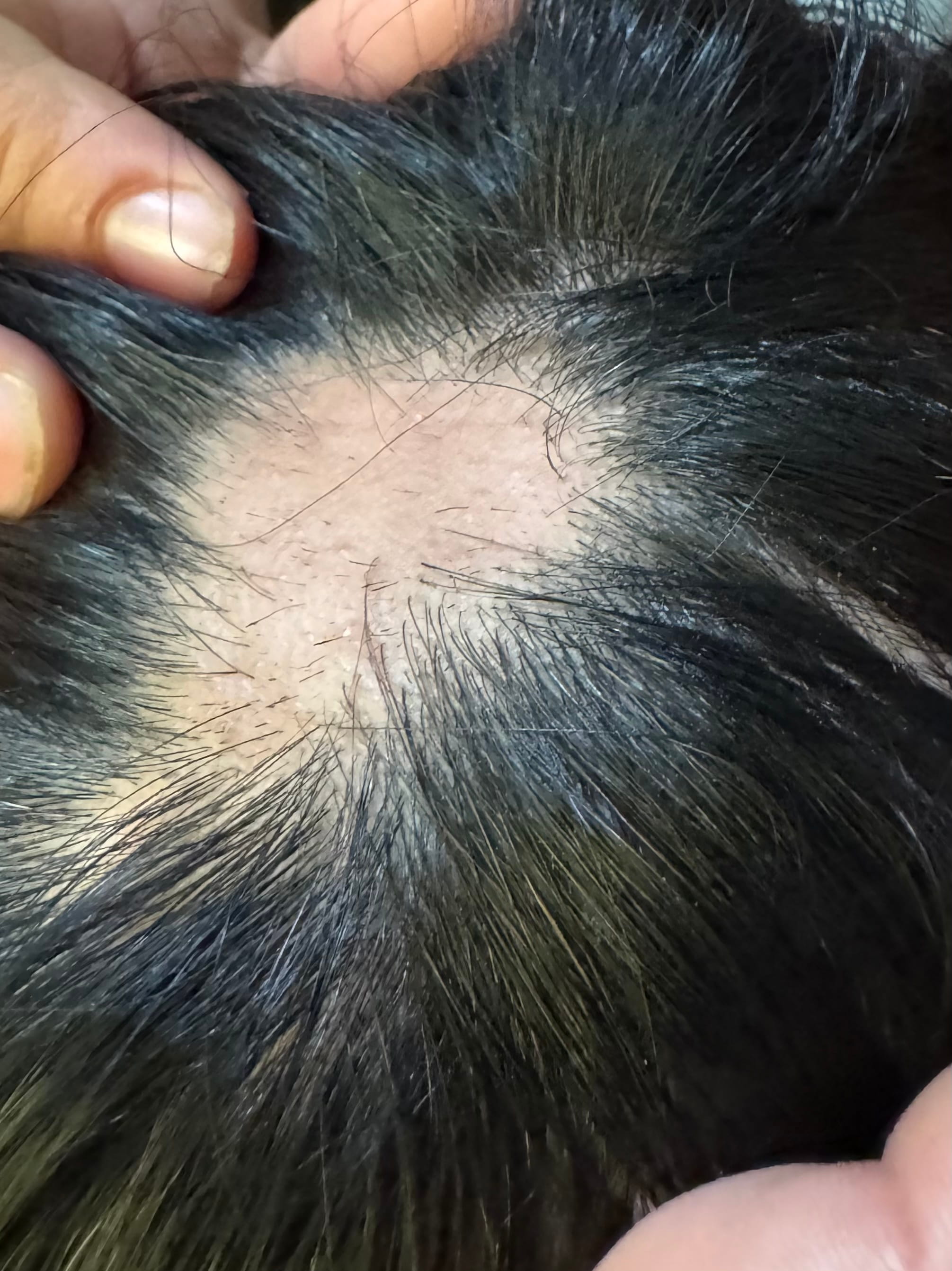 ALOPECIA AREATA