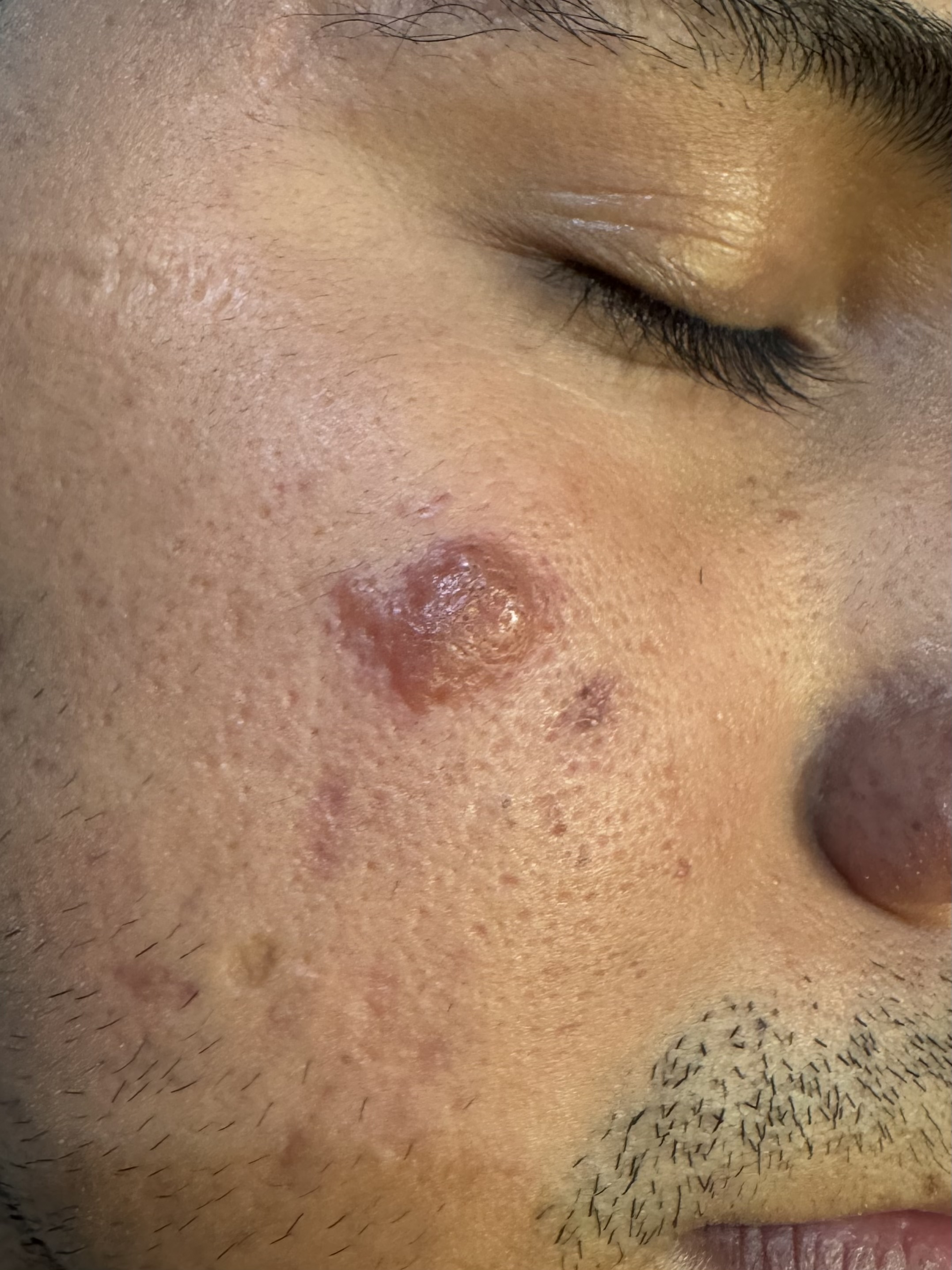 LEISHMANIASIS CUTANEA