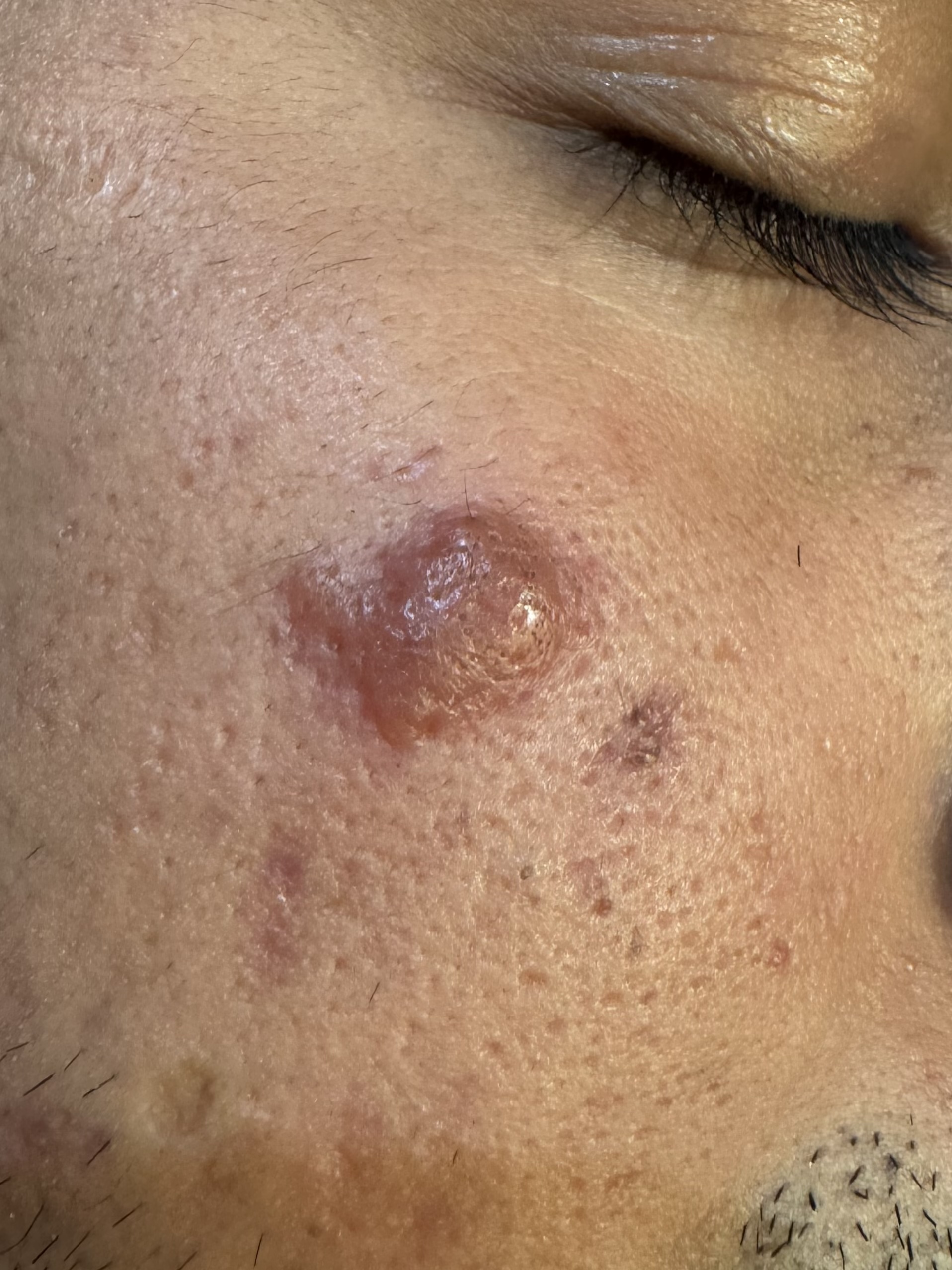 LEISHMANIASIS CUTANEA