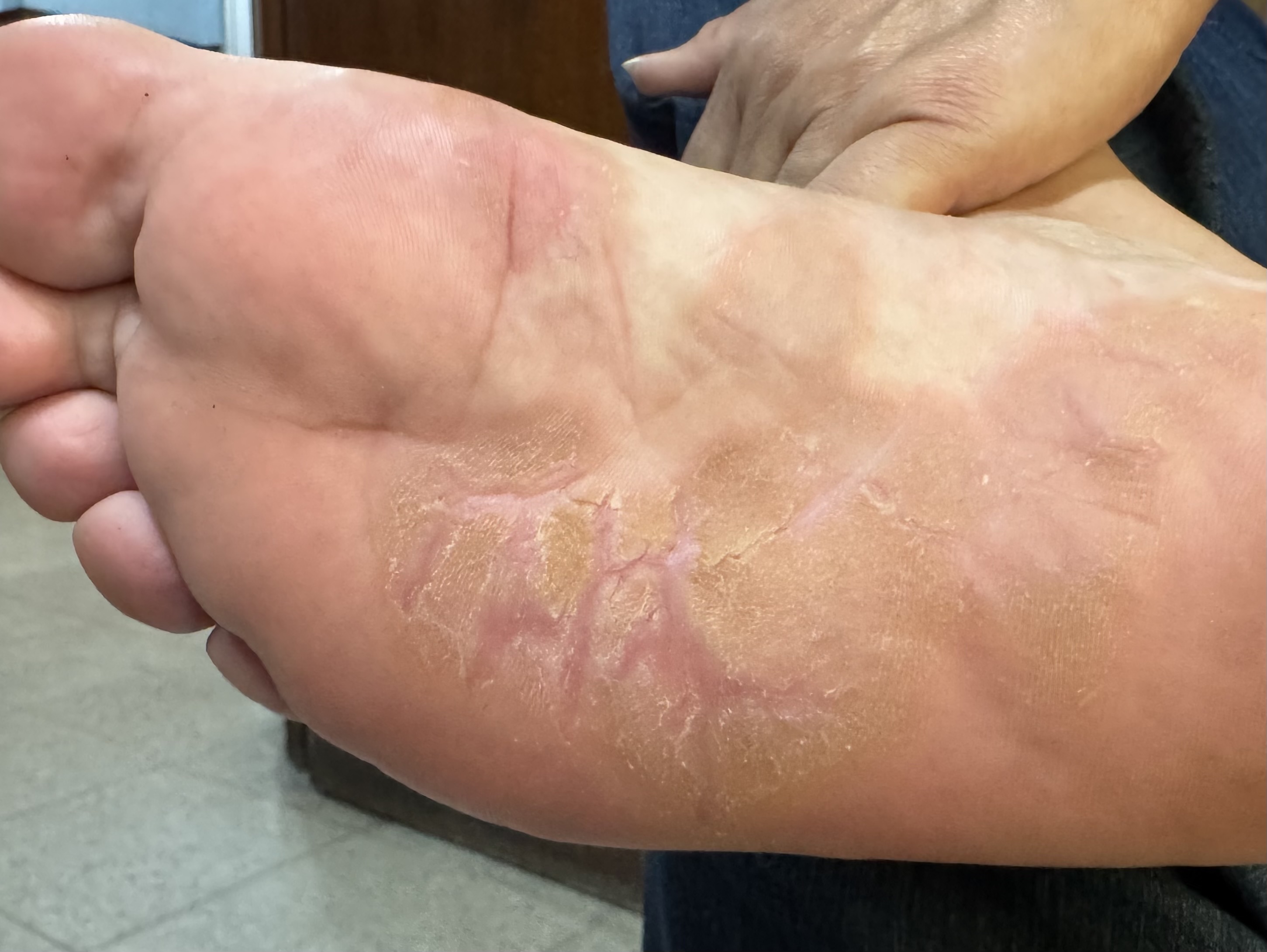 QUERATODERMIA PLANTAR