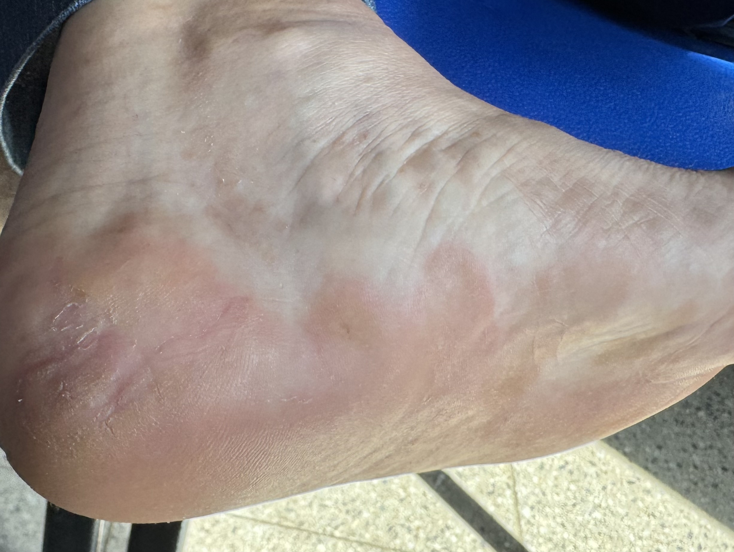 QUERATODERMIA PLANTAR