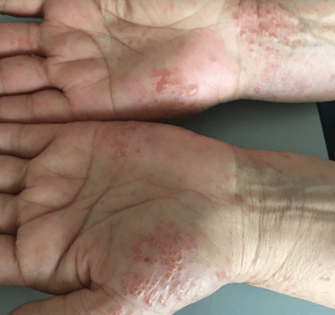 DISHIDROSIS