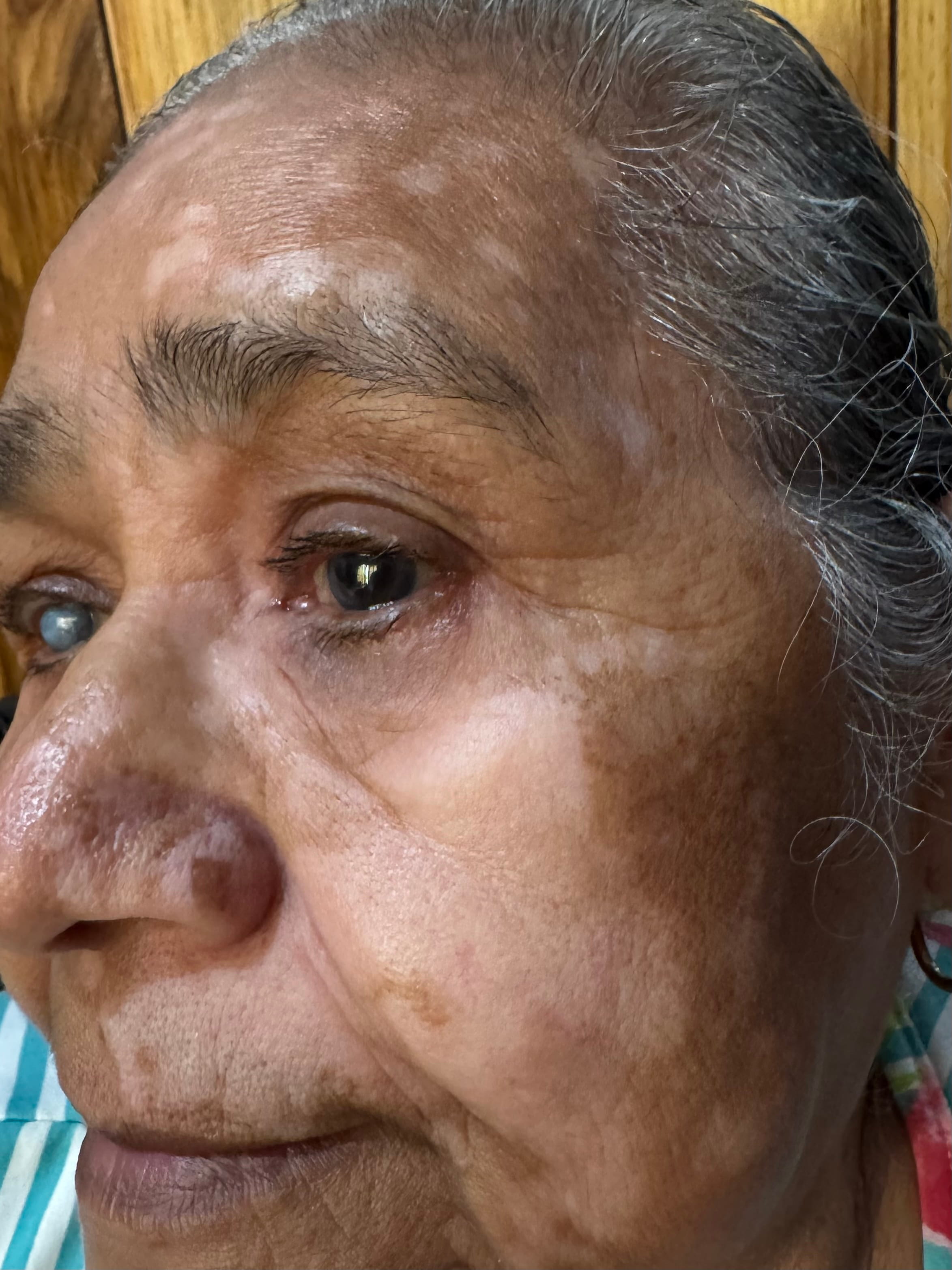 VITILIGO SEGMENTARIO