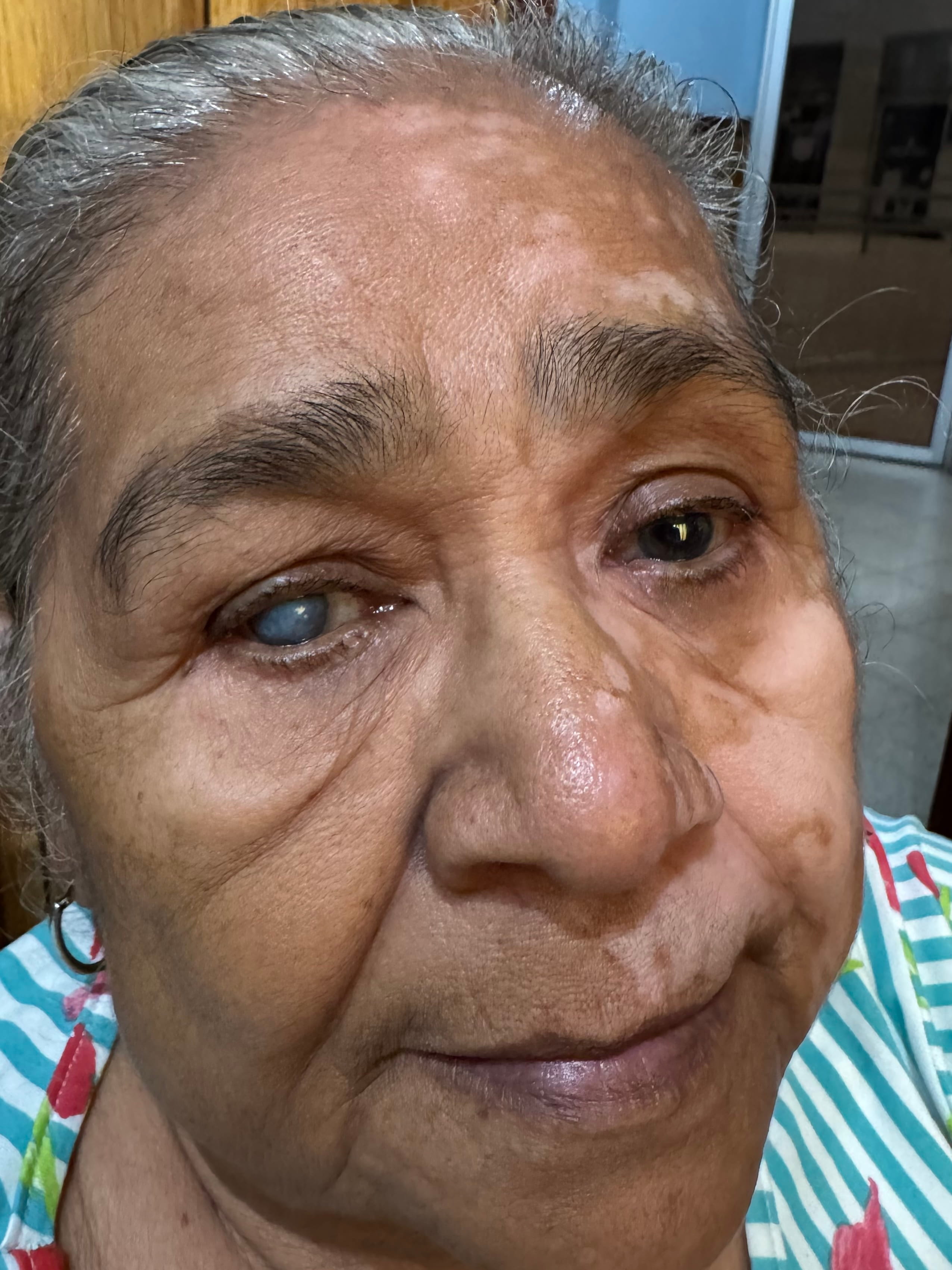 VITILIGO SEGMENTARIO