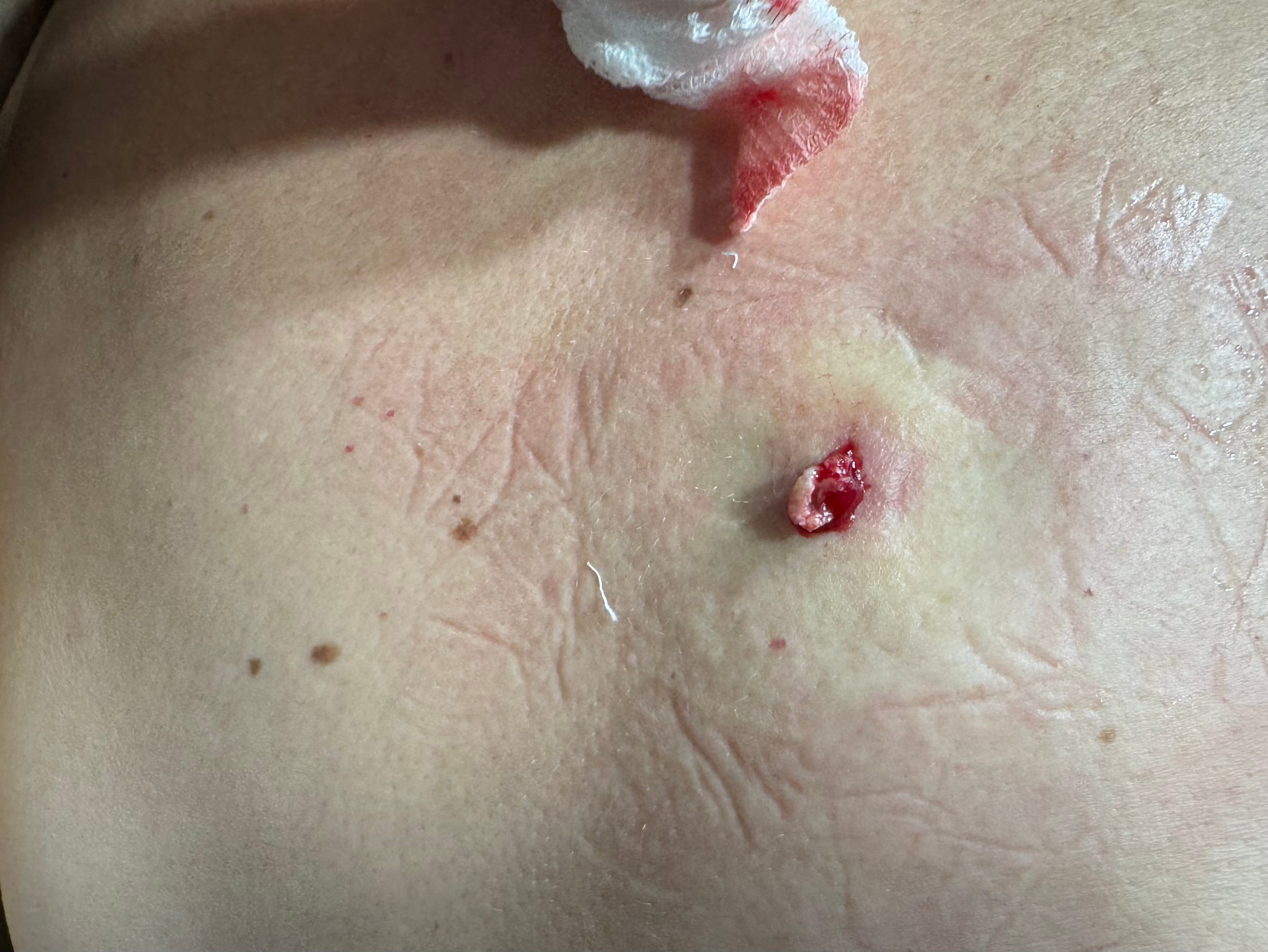 QUISTE DE INCLUSION EPIDERMICA Infectado