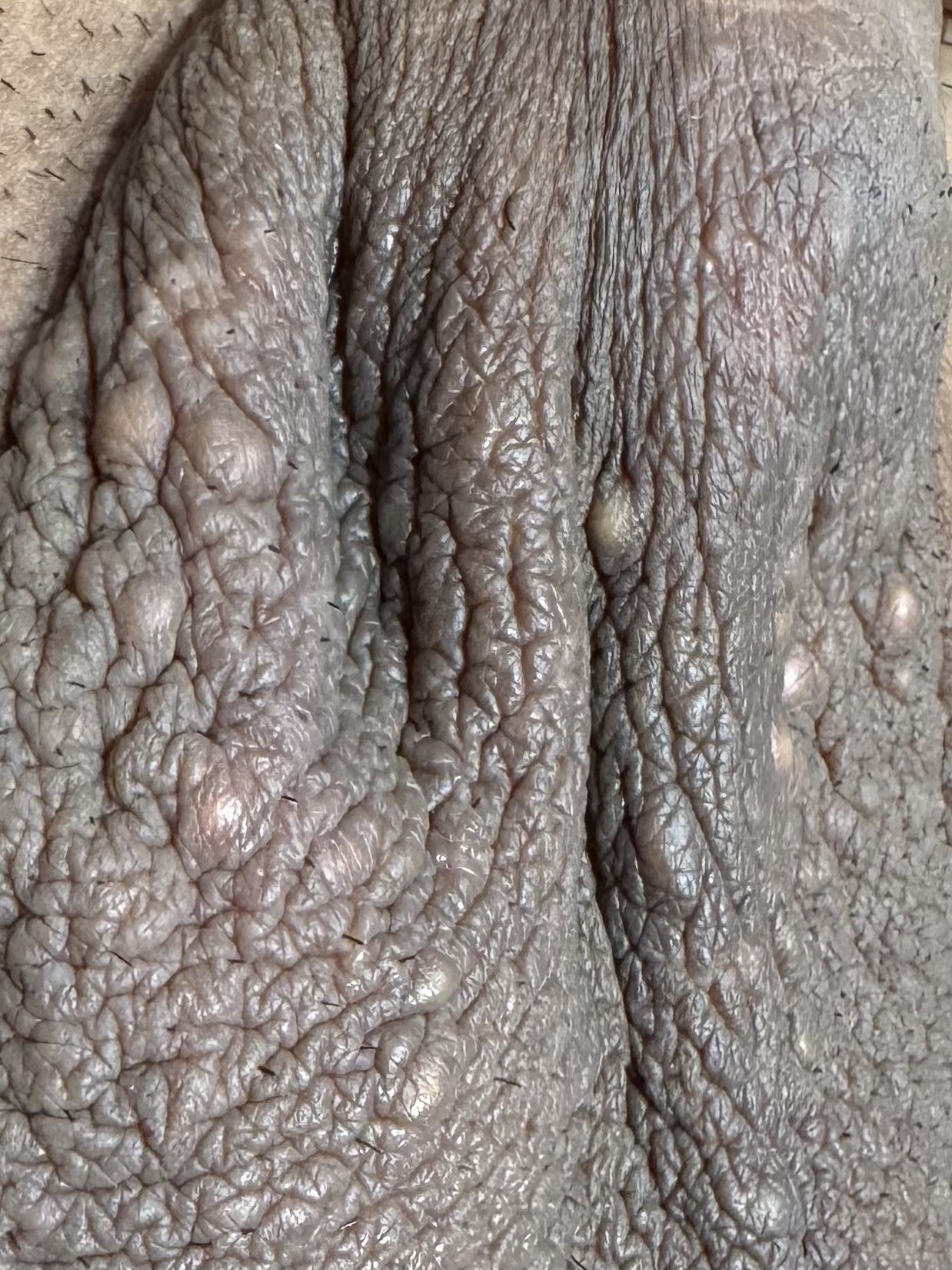 QUISTE DE INCLUSION EPIDERMICA en escroto