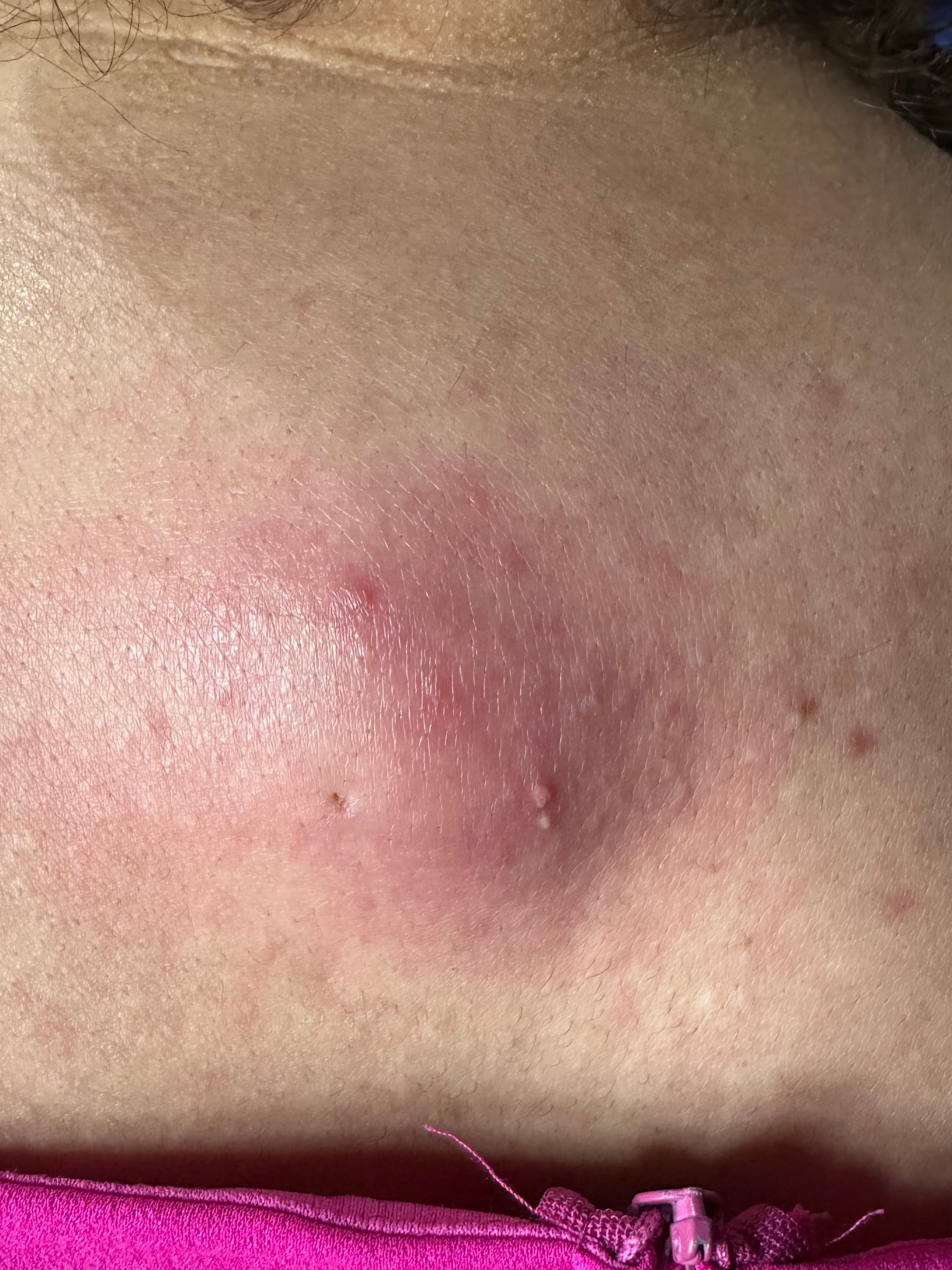 QUISTE DE INCLUSION EPIDERMICA Infectado