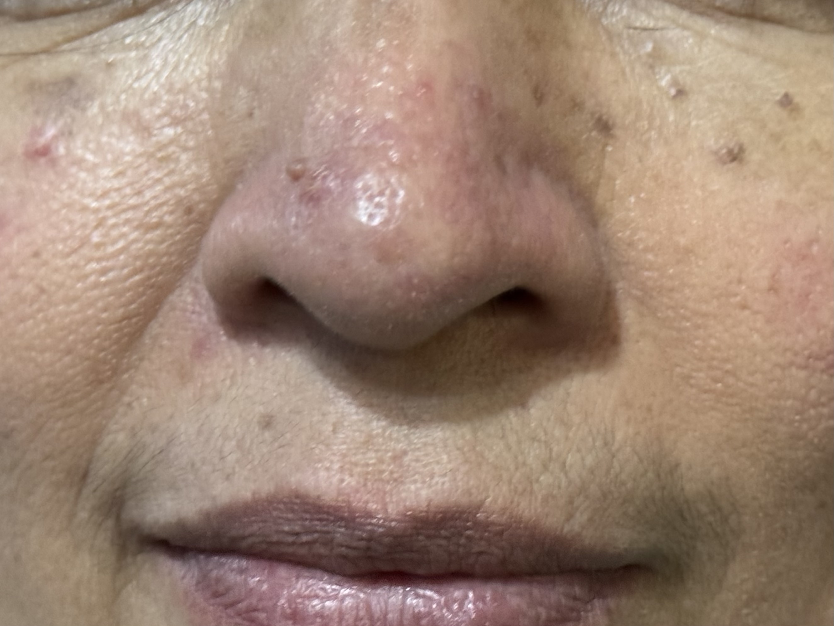 ROSACEA en remisión y Queratosis Seborréicas