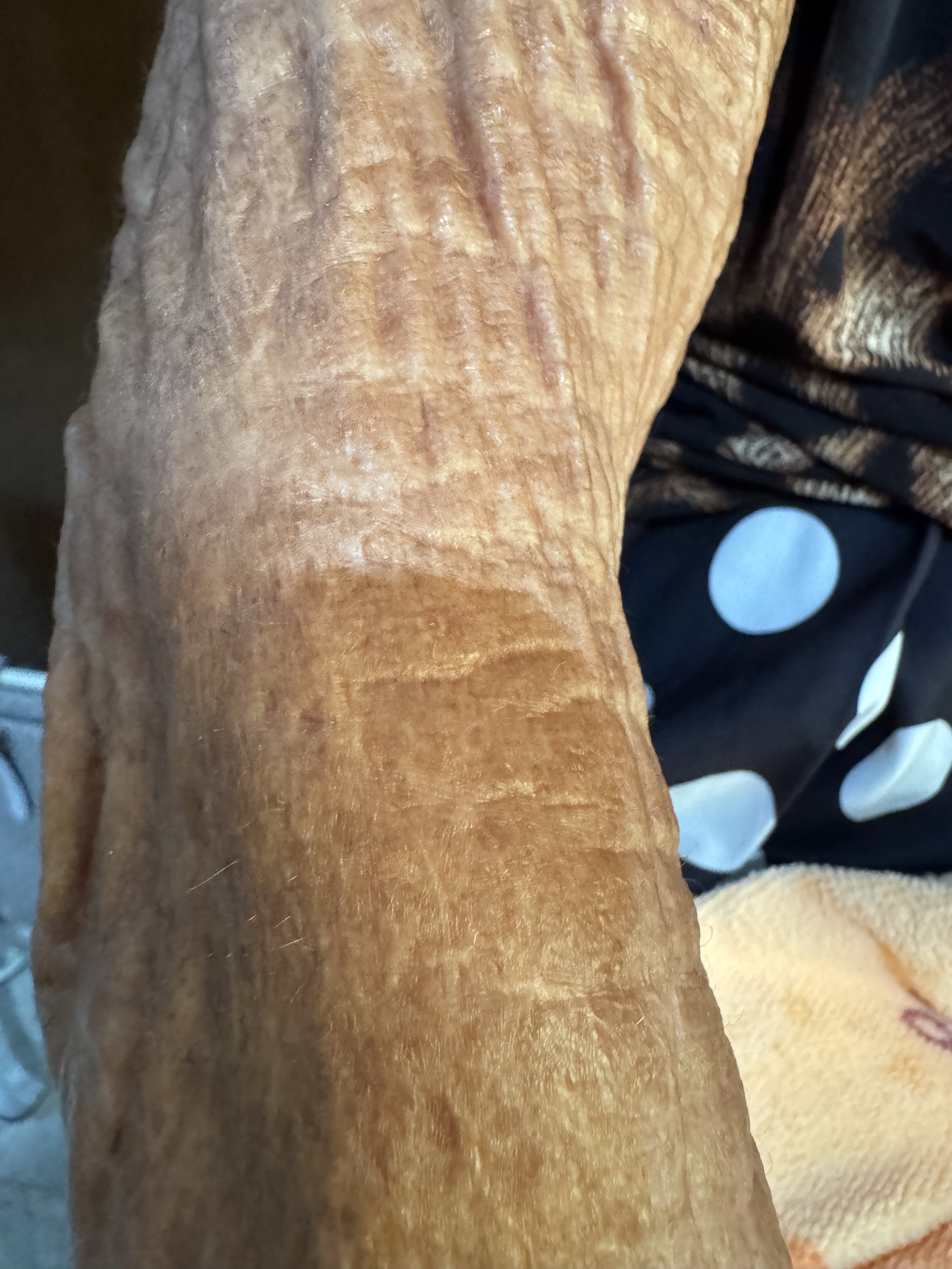 DERMATITIS SOLAR CRONICA - Dermatoheliosis