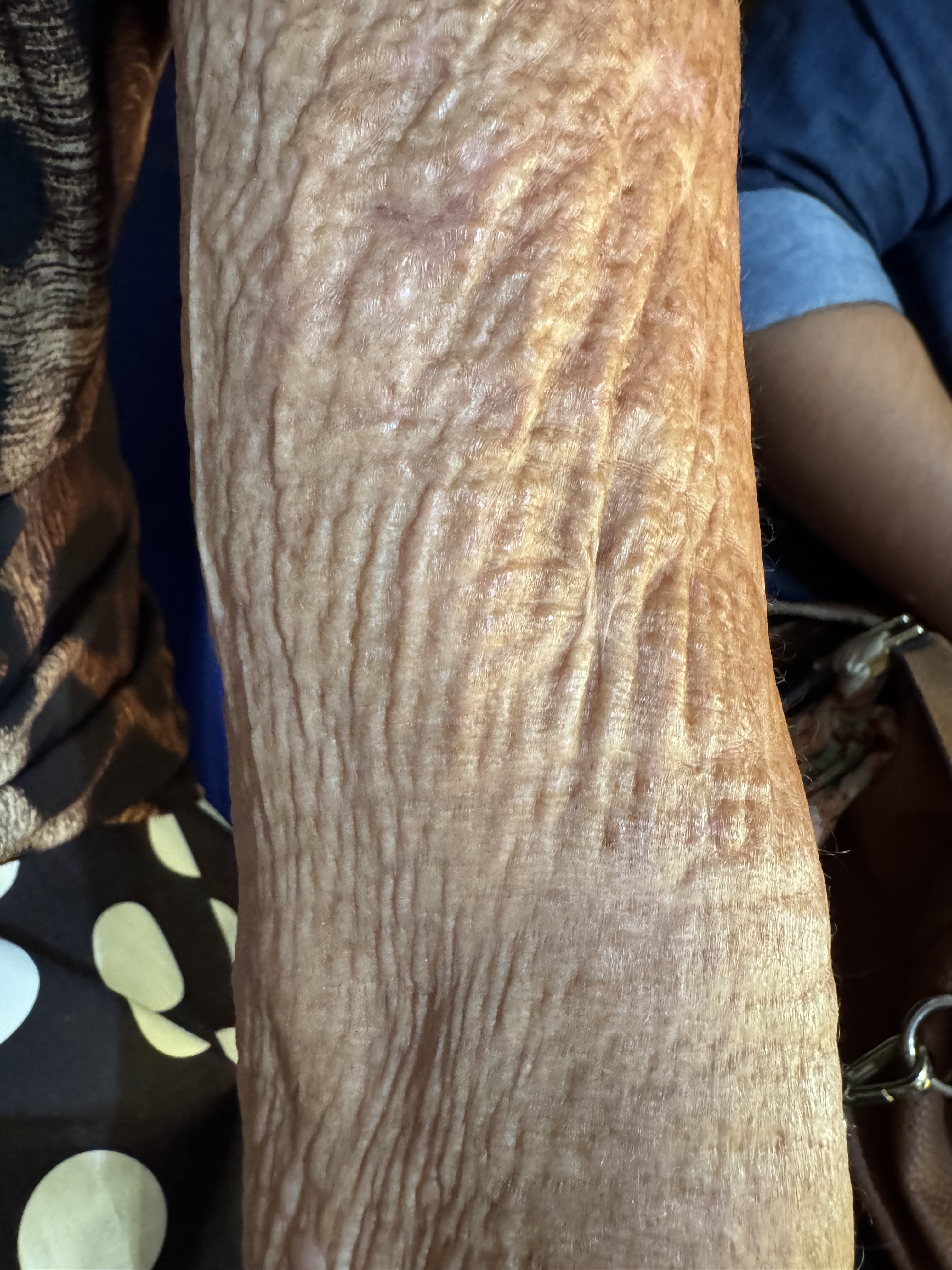 DERMATITIS SOLAR CRONICA - Dermatoheliosis