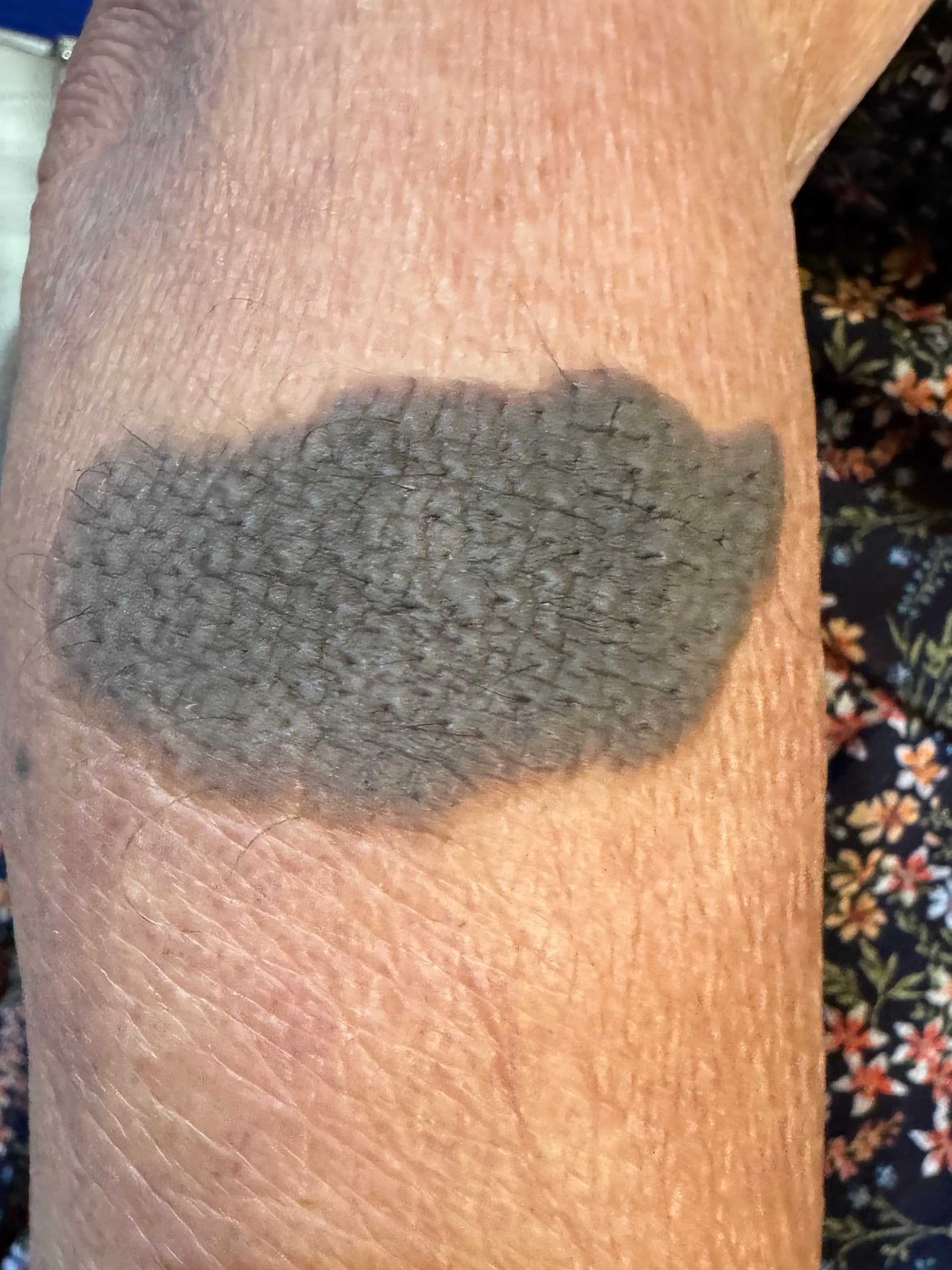 NEVO PIGMENTADO PILOSO Gigante