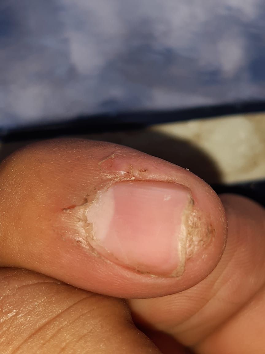 VERRUGA VULGAR Subungueal