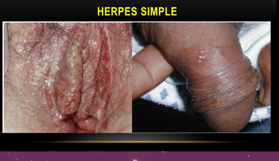 HERPES SIMPLE - Genital