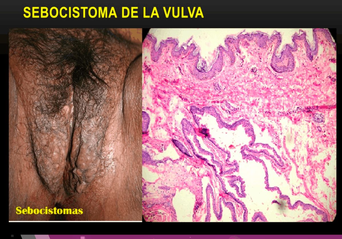 SEBOCISTOMA VULVAR