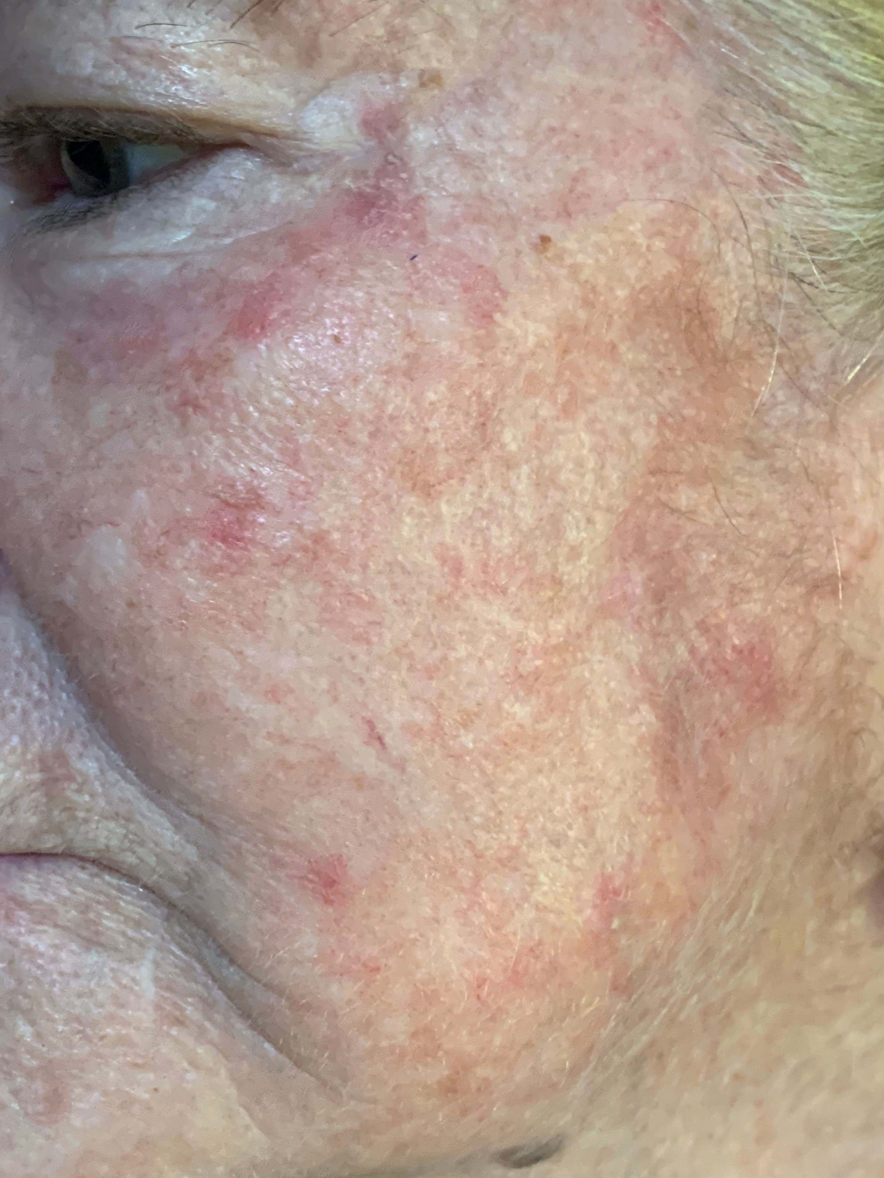 QUERATOSIS ACTINICAS