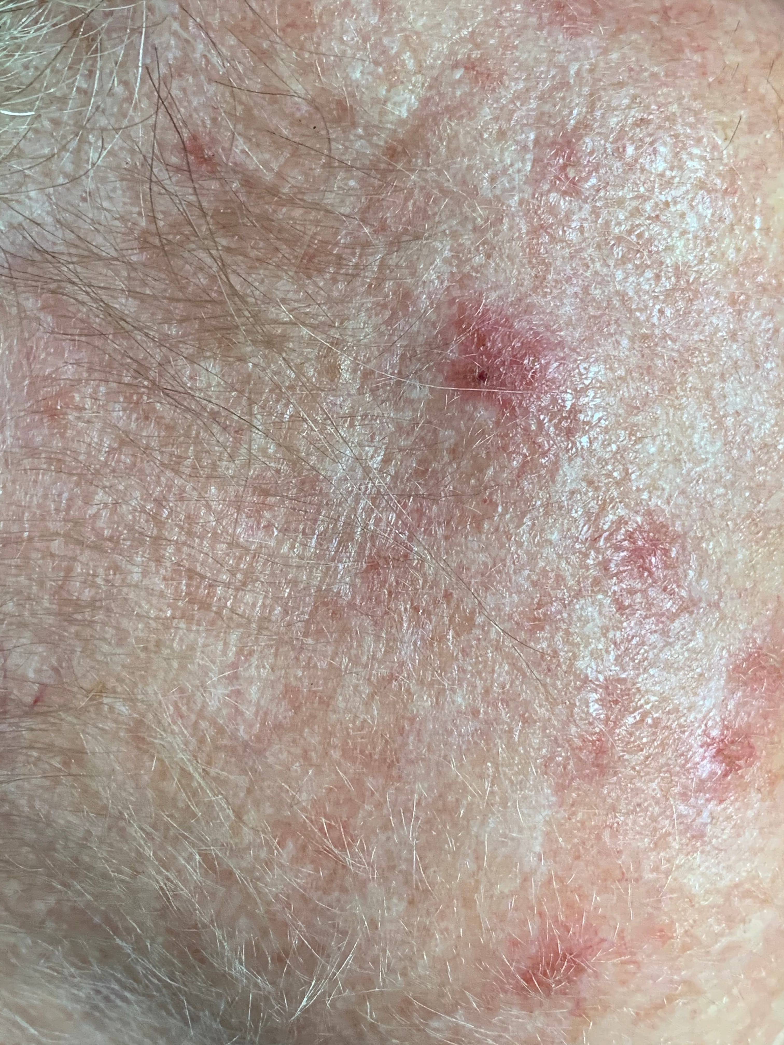 QUERATOSIS ACTINICAS