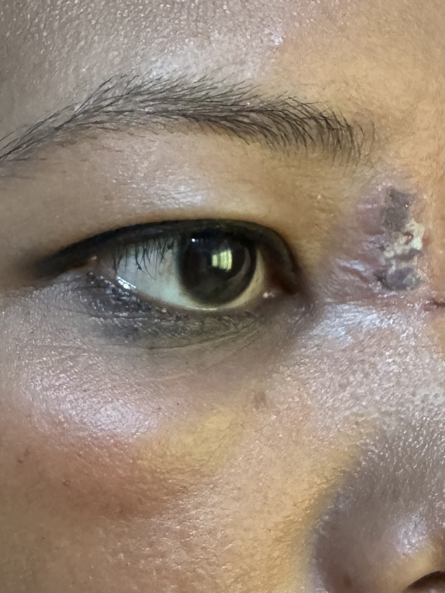 IMPETIGO - EDEMA PARPADO