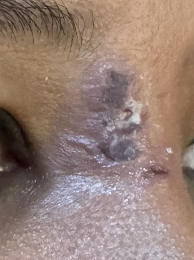 IMPETIGO - EDEMA PARPADO