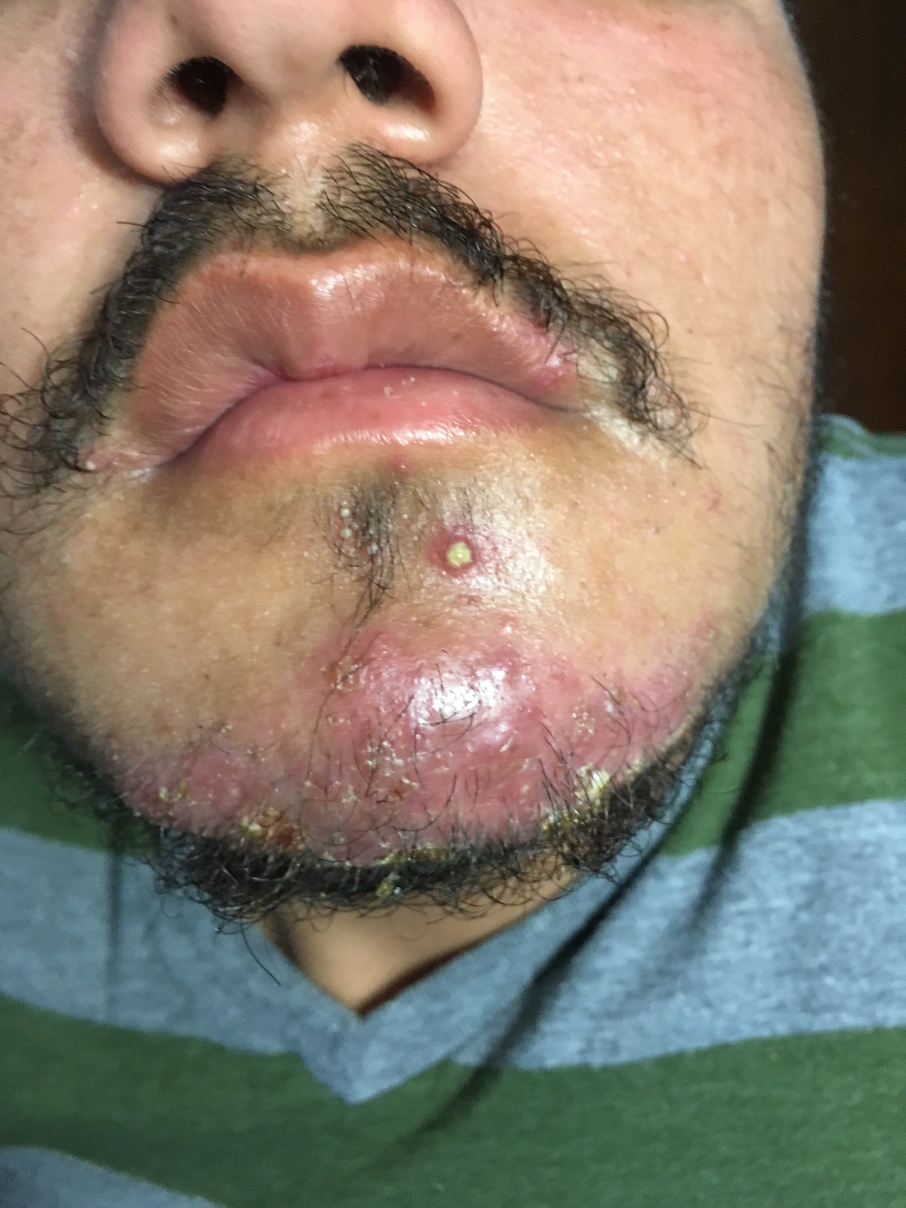 CELULITIS del mentón